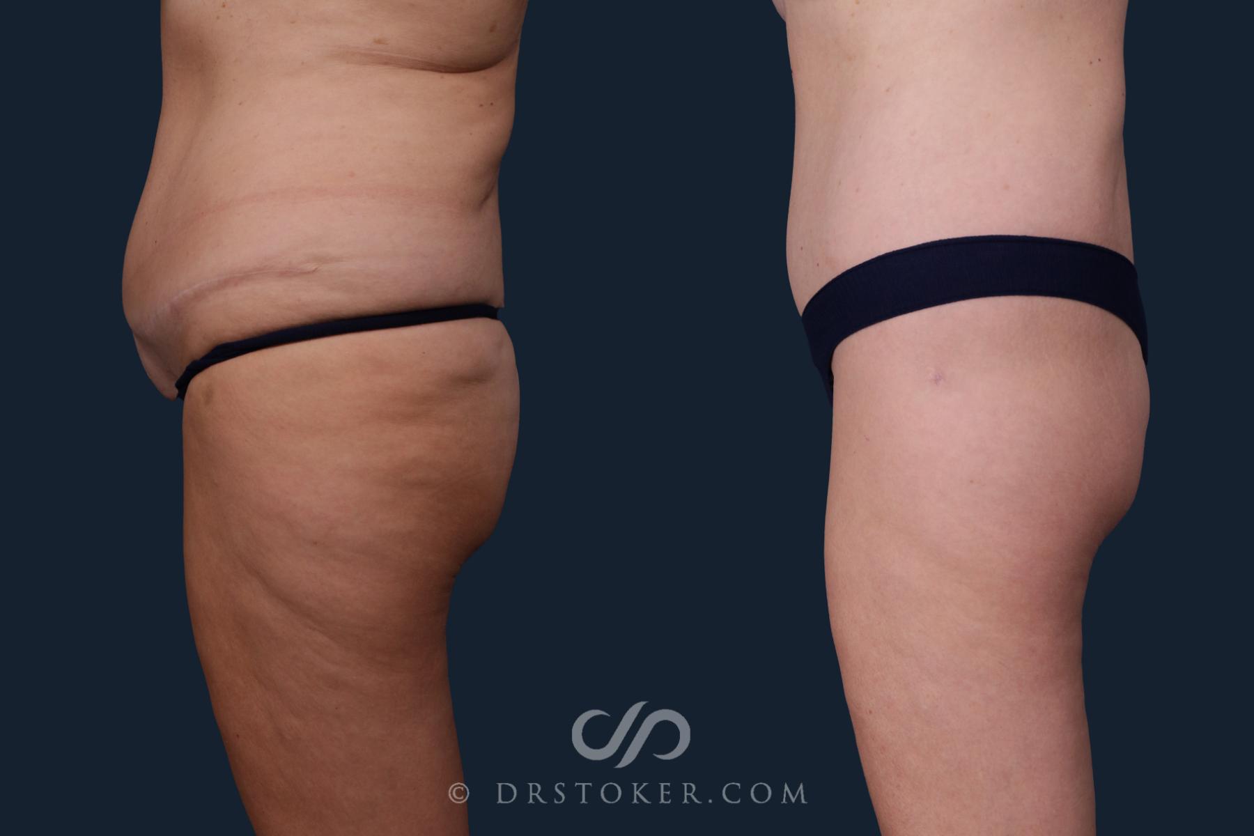 Before & After Body Lift Case 2214 Left Side View in Los Angeles, CA