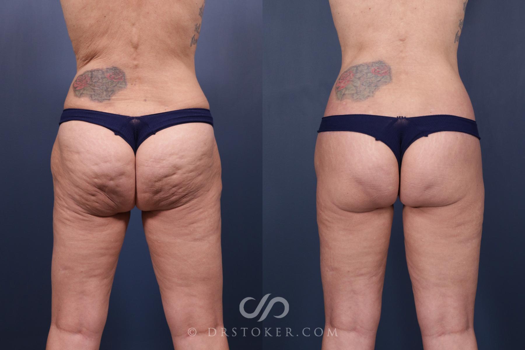 Before & After Body Lift Case 2331 Back View in Los Angeles, CA