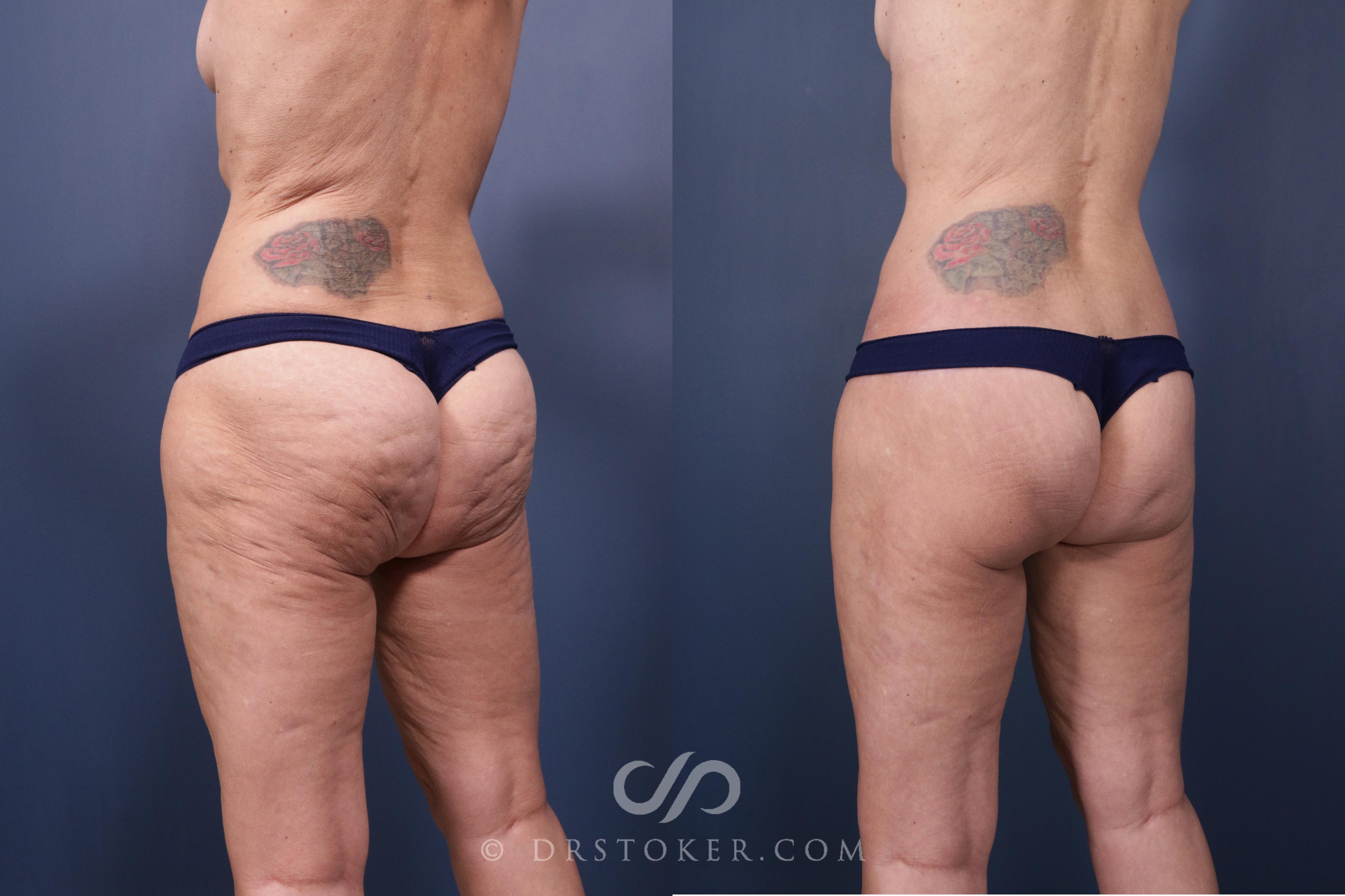 Before & After Body Lift Case 2331 Left Side View in Los Angeles, CA