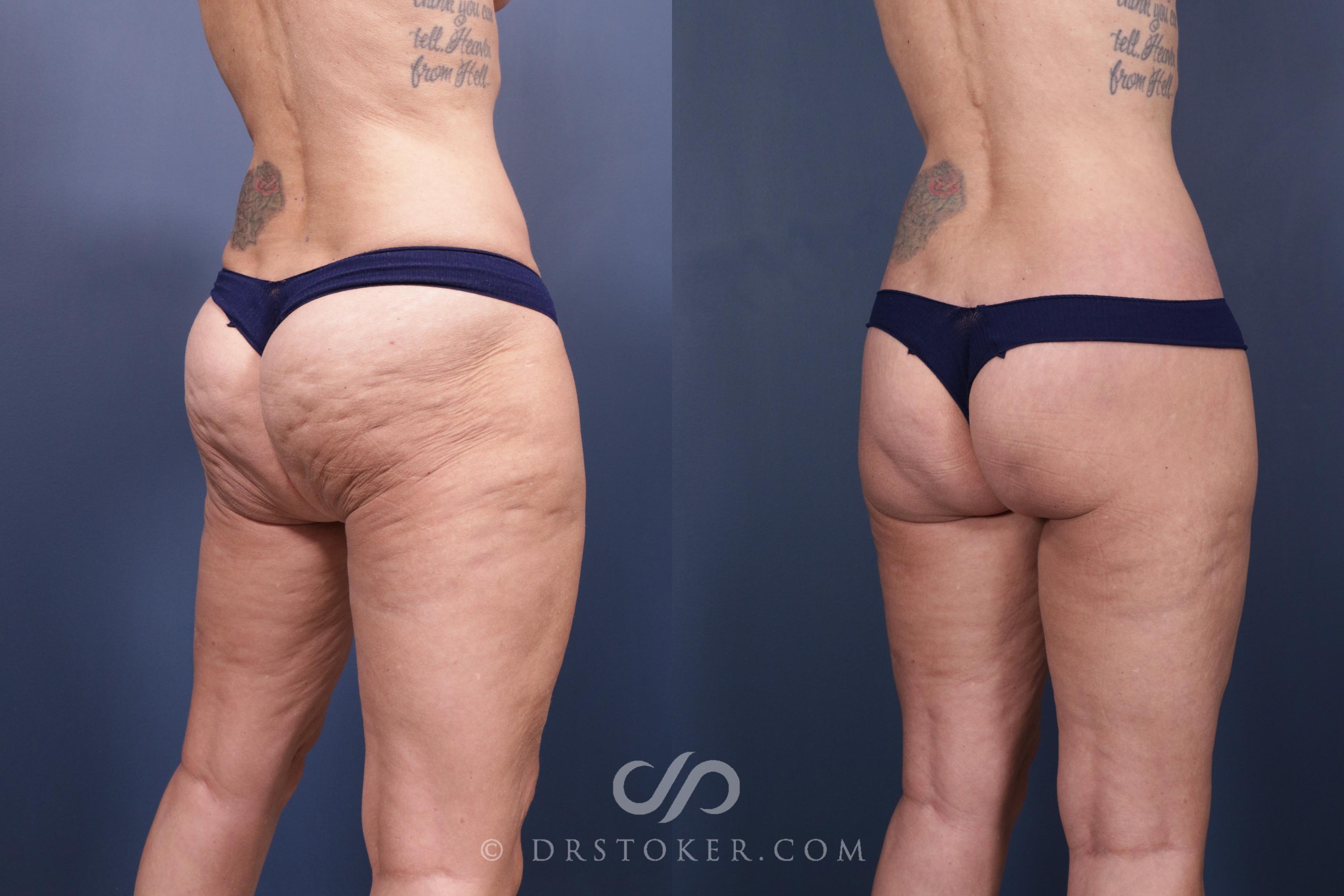 Before & After Body Lift Case 2331 Right Side View in Los Angeles, CA