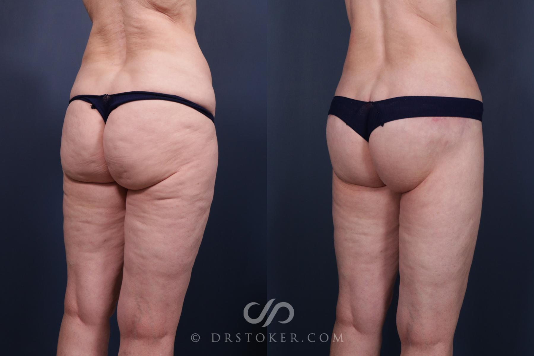 Before & After Body Lift Case 2670 Right Oblique View in Los Angeles, CA