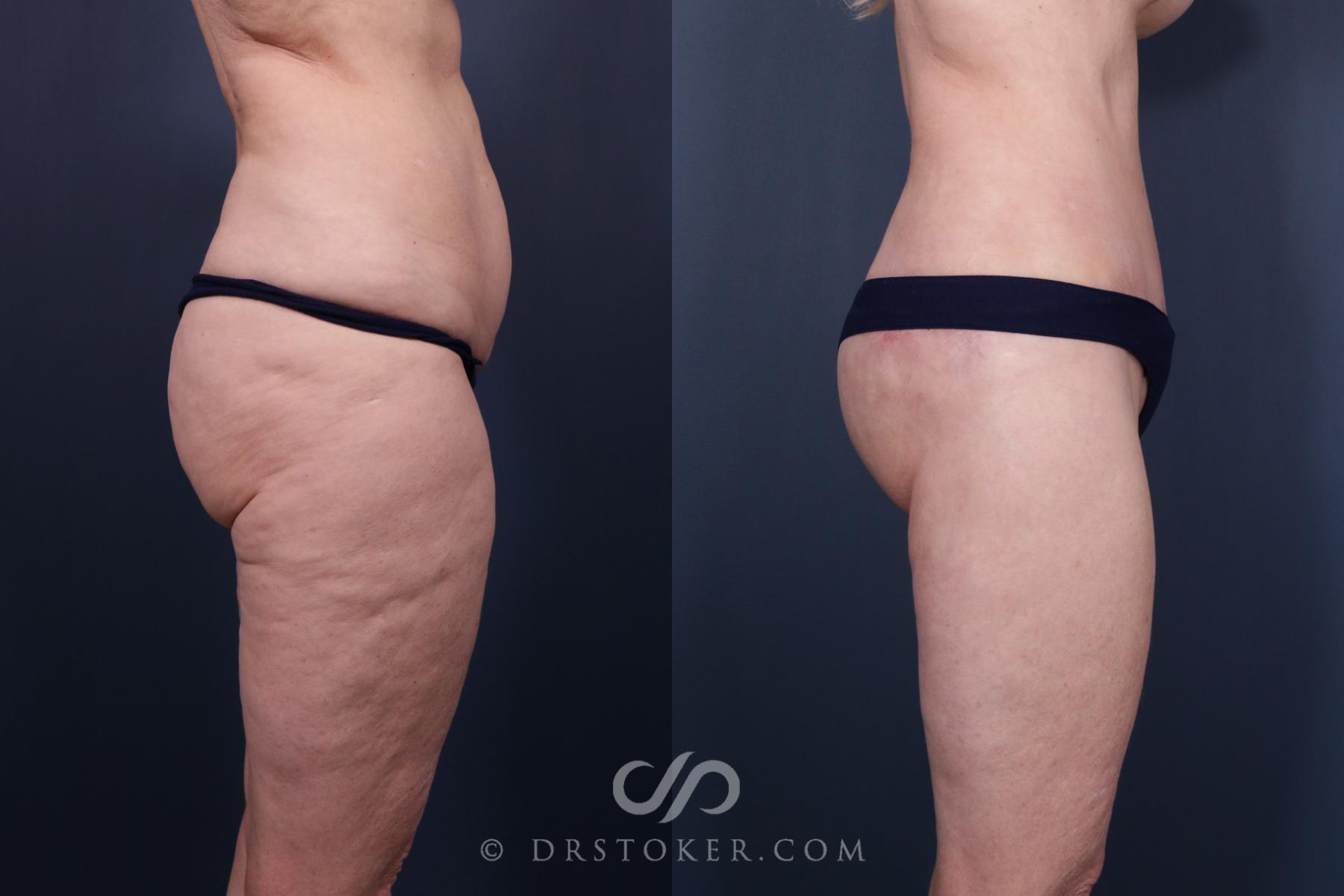 Before & After Body Lift Case 2670 Right Side View in Los Angeles, CA