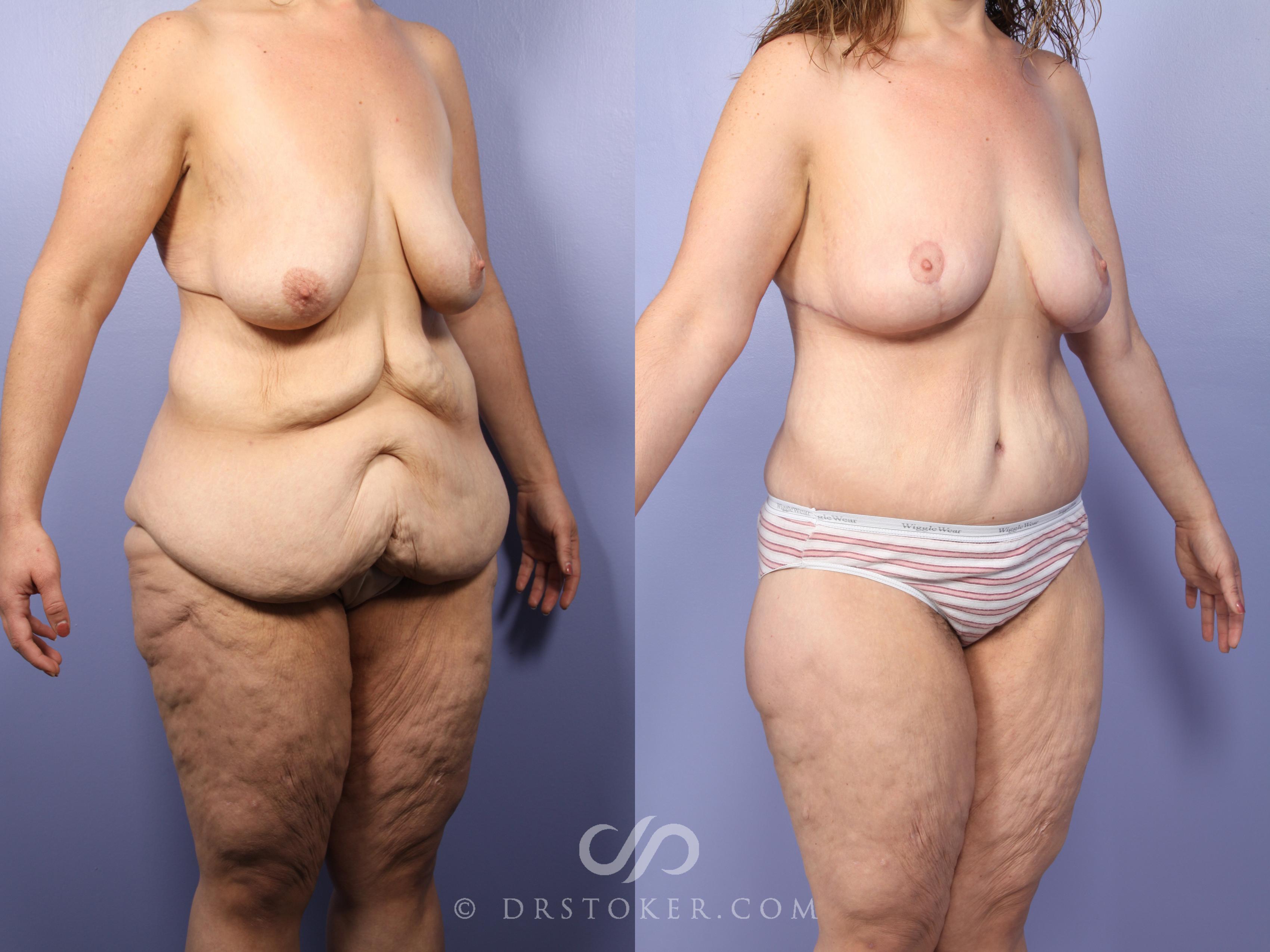 Before & After Body Lift Case 398 View #2 View in Los Angeles, CA