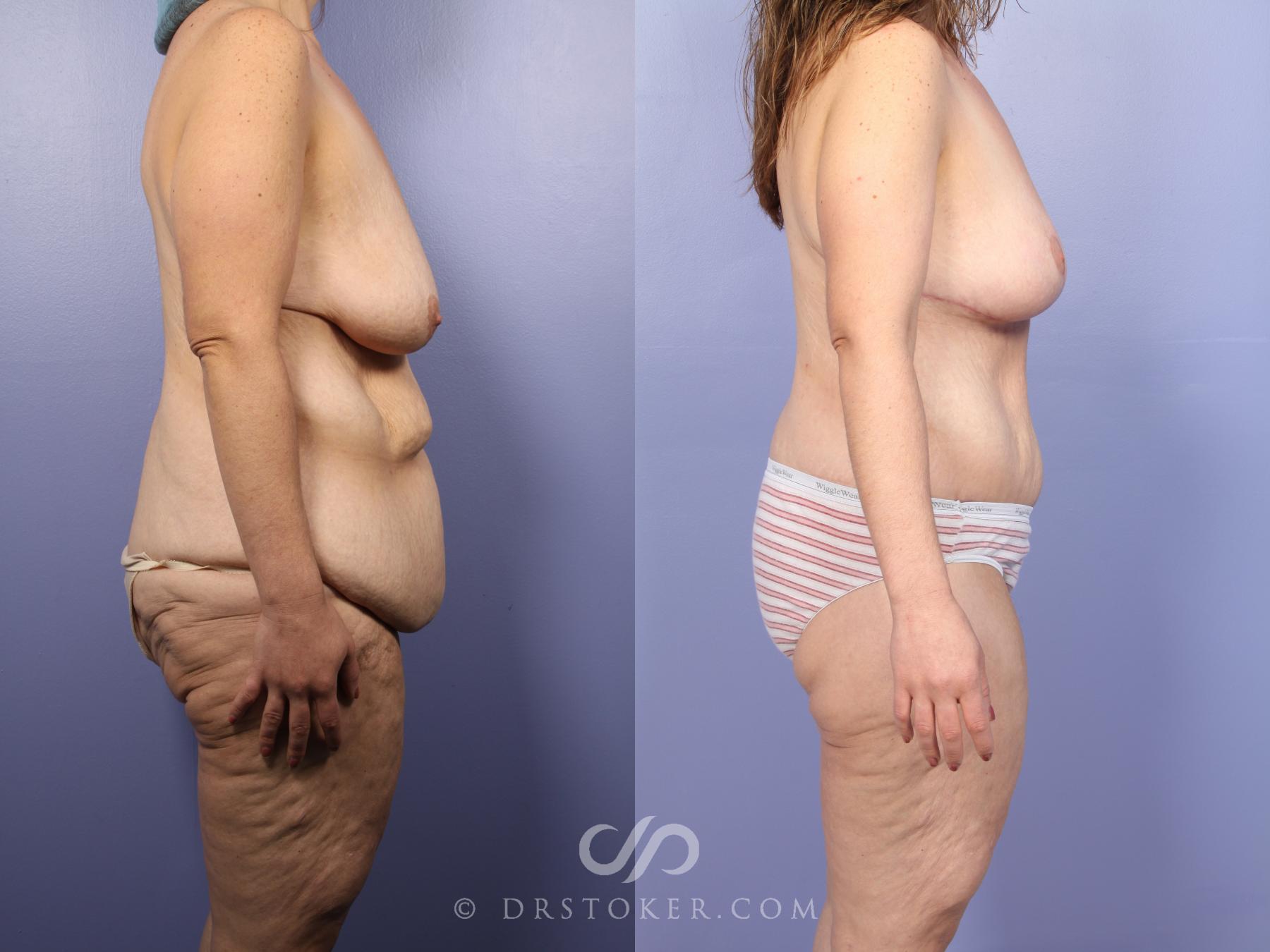 Before & After Body Lift Case 398 View #3 View in Los Angeles, CA