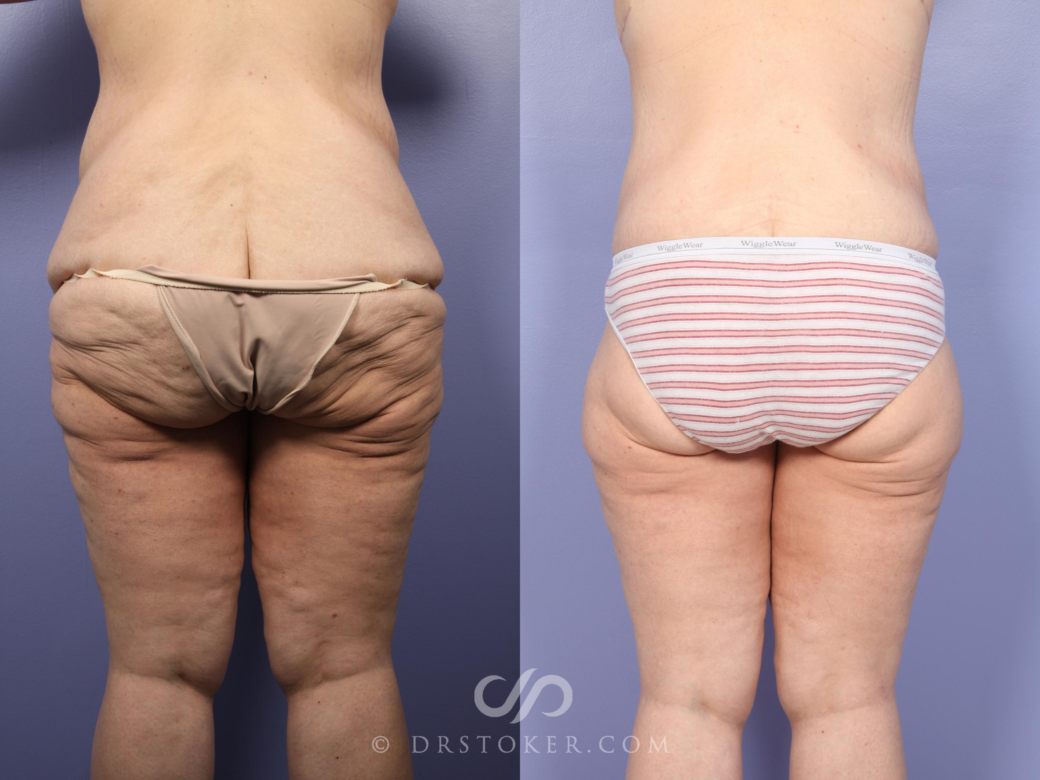 Before & After Body Lift Case 398 View #5 View in Los Angeles, CA