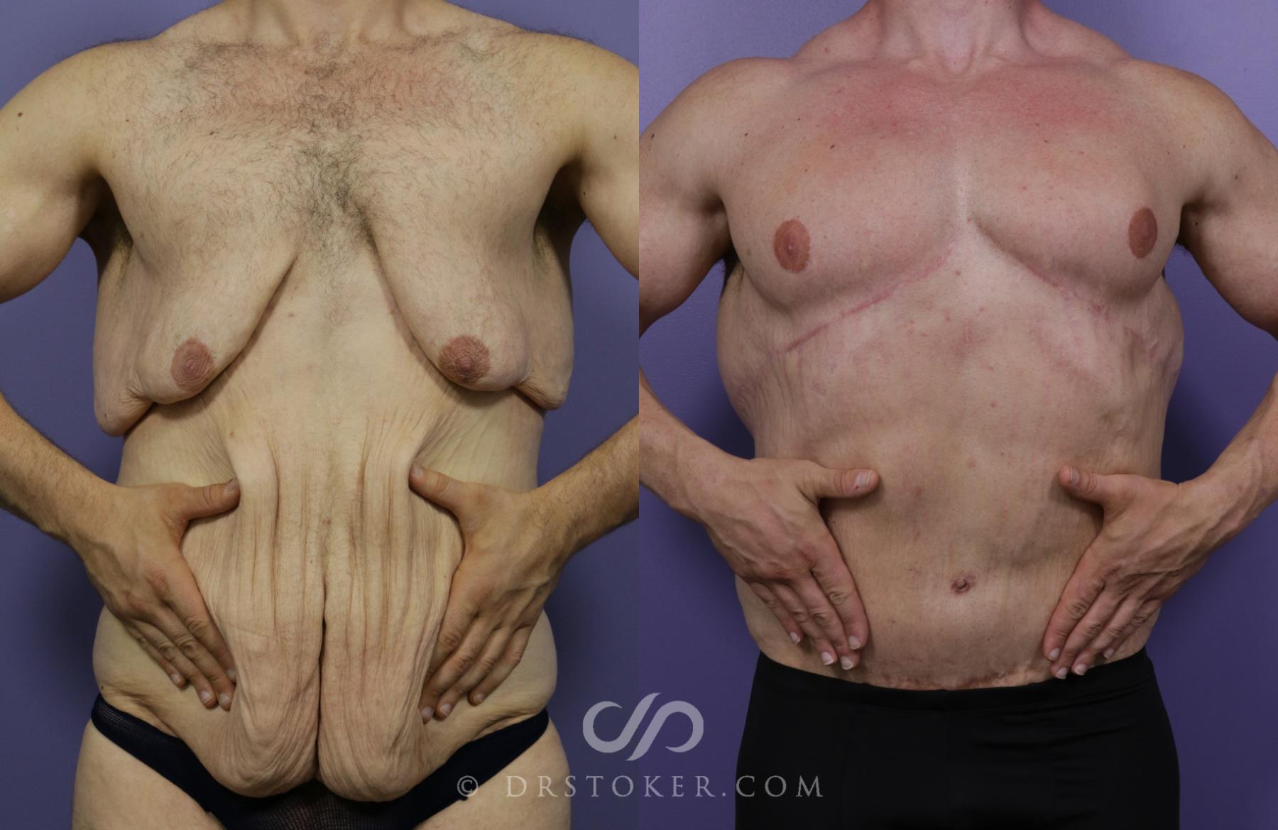 Before & After Breast Reduction for Men (Gynecomastia) Case 1714 View #1 View in Los Angeles, CA