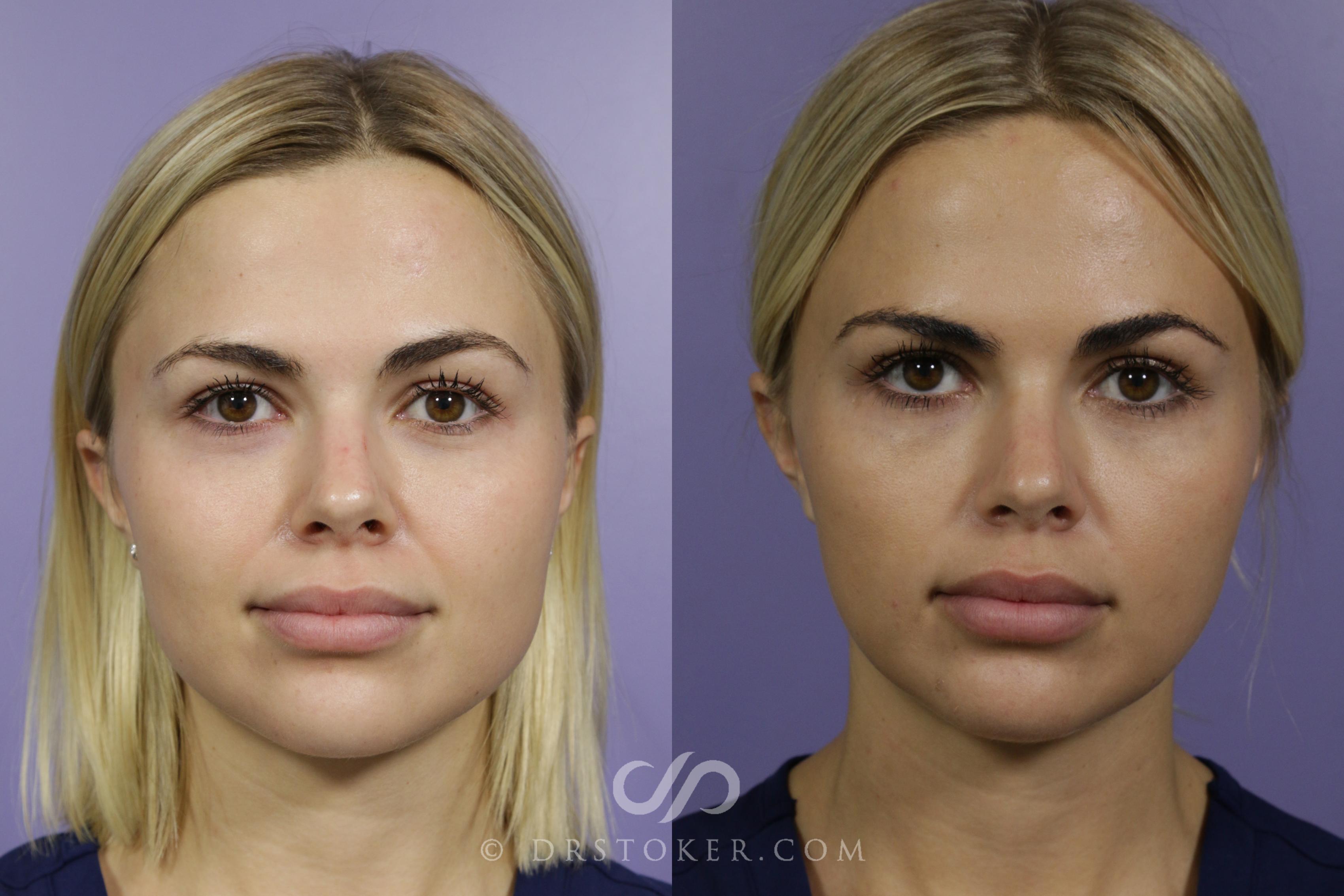 Before & After Prejuvenation (Nonsurgical) Case 1579 View #1 View in Marina del Rey, CA