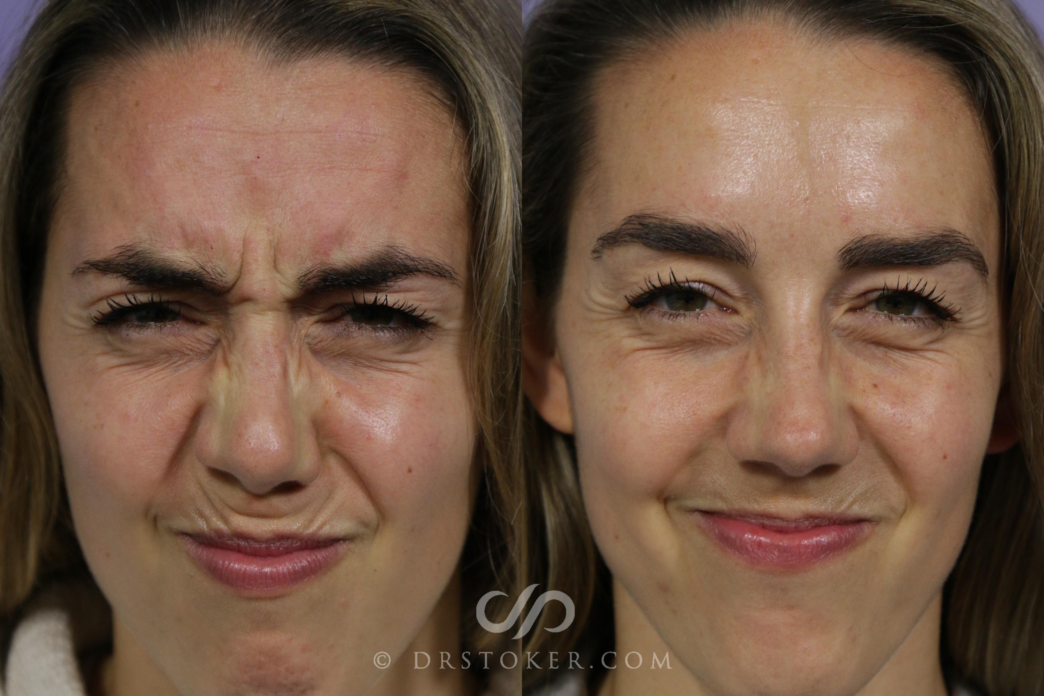 Before & After BOTOX®, Dysport®, & Jeuveau® Case 1584 View #1 View in Marina del Rey, CA