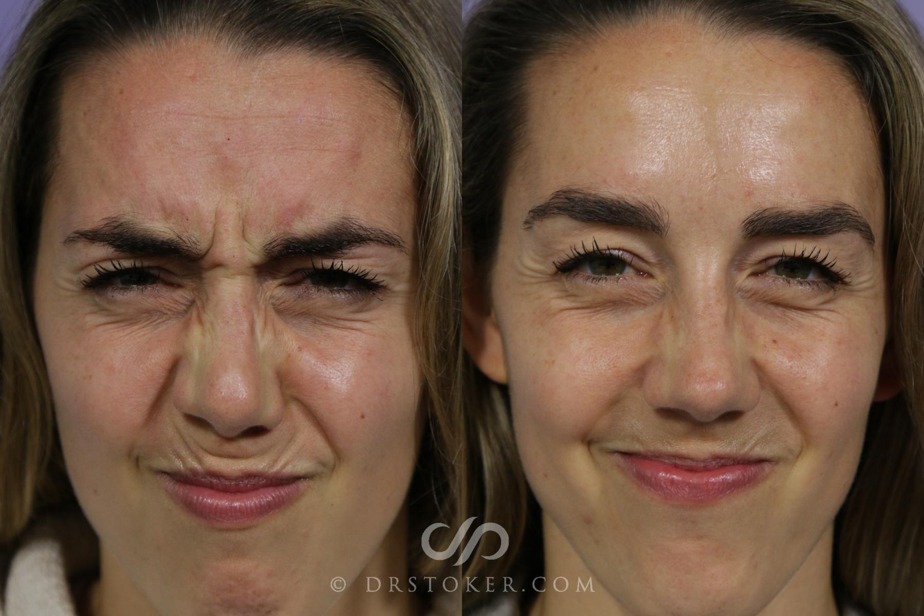 Before & After BOTOX®, Dysport®, & Jeuveau® Case 1584 View #1 View in Los Angeles, CA