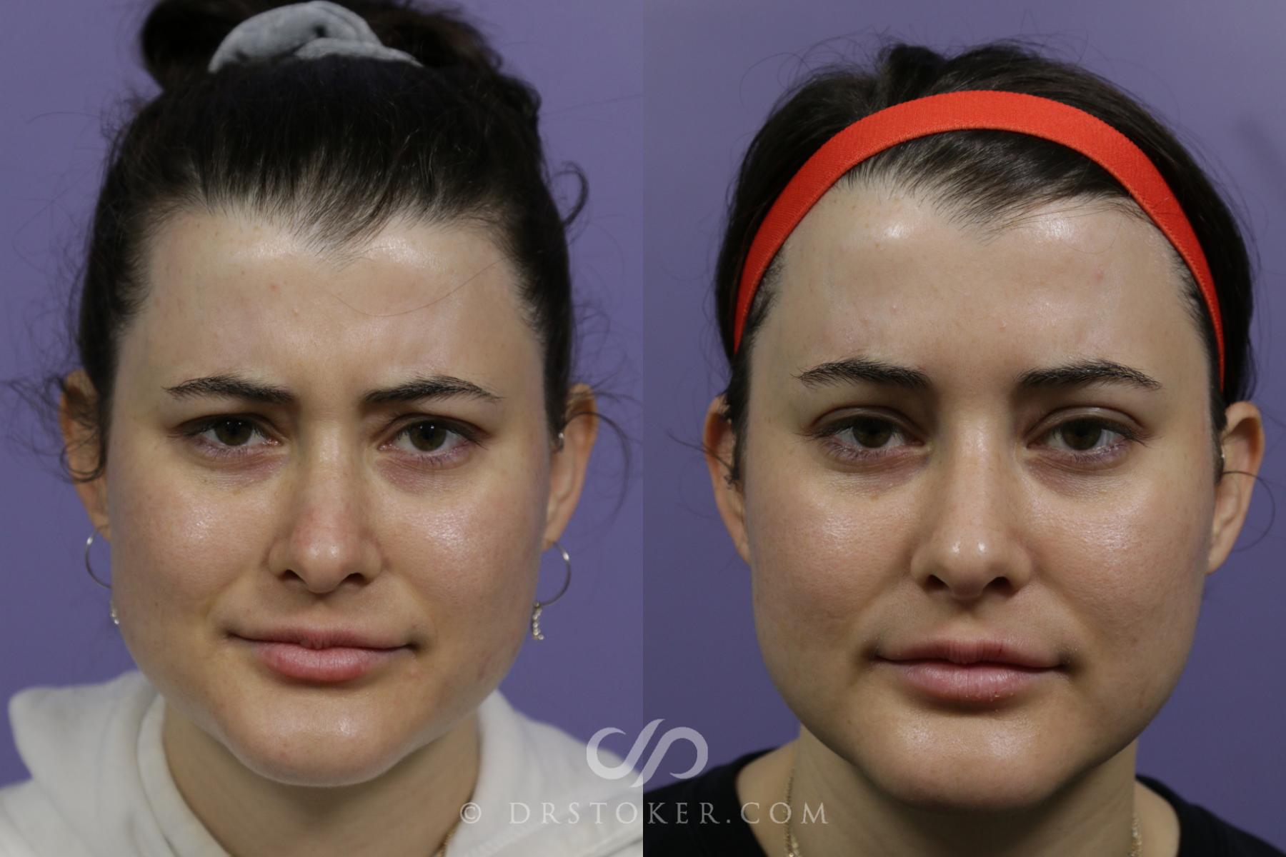 Before & After BOTOX®, Dysport®, & Jeuveau® Case 1603 View #1 View in Los Angeles, CA