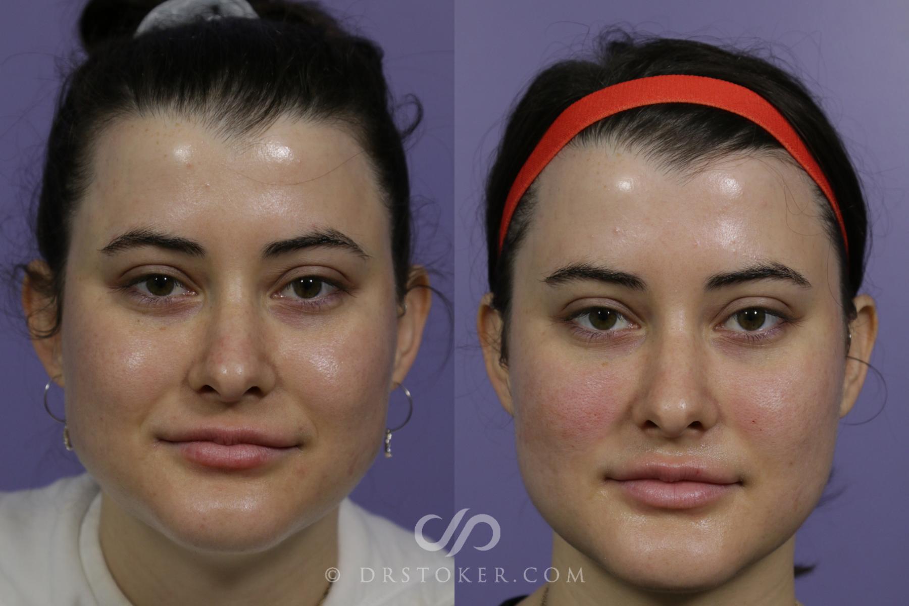 Before & After BOTOX®, Dysport®, & Jeuveau® Case 1604 View #1 View in Los Angeles, CA