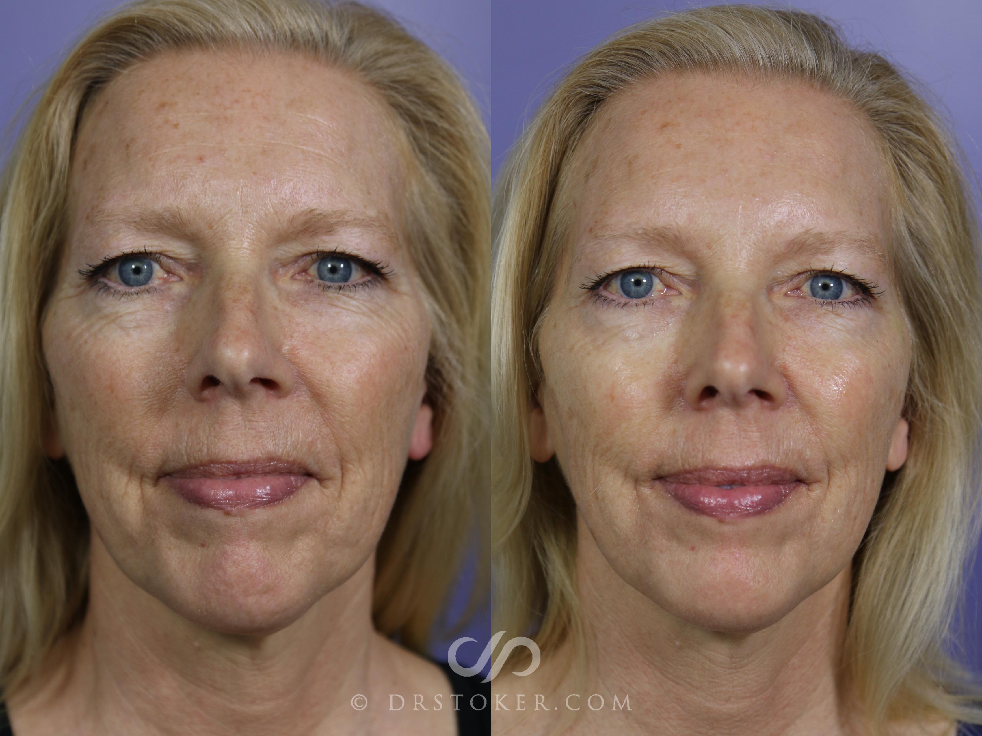 Before & After BOTOX®, Dysport®, & Jeuveau® Case 1607 View #1 View in Marina del Rey, CA