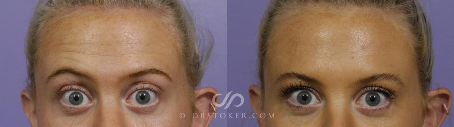 Before & After BOTOX®, Dysport®, & Jeuveau® Case 1609 View #1 View in Los Angeles, CA