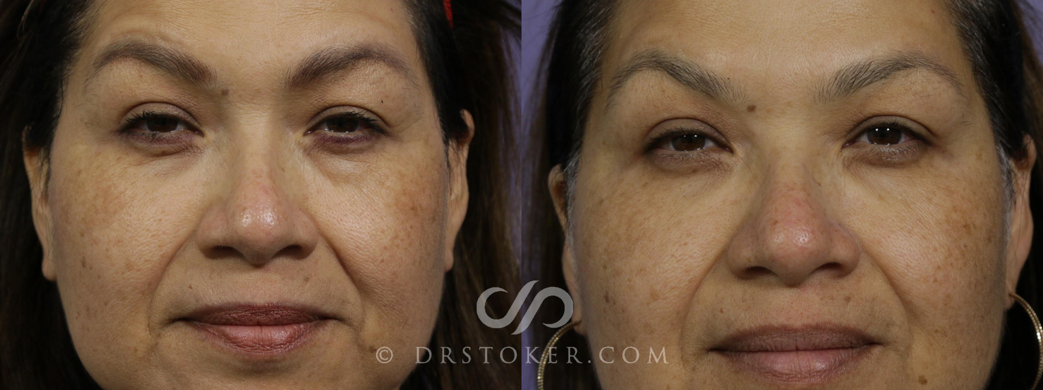Before & After BOTOX®, Dysport®, & Jeuveau® Case 1613 View #1 View in Los Angeles, CA