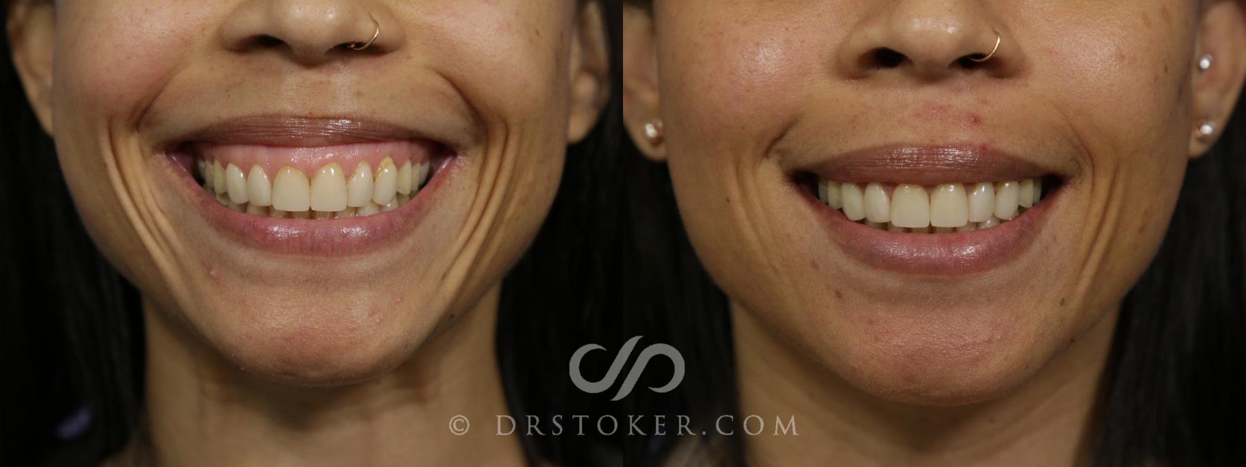 Before & After BOTOX®, Dysport®, & Jeuveau® Case 1620 View #1 View in Los Angeles, CA