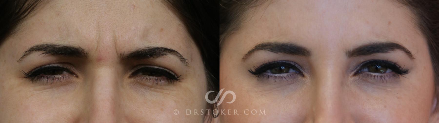 Before & After BOTOX®, Dysport®, & Jeuveau® Case 1625 View #1 View in Los Angeles, CA