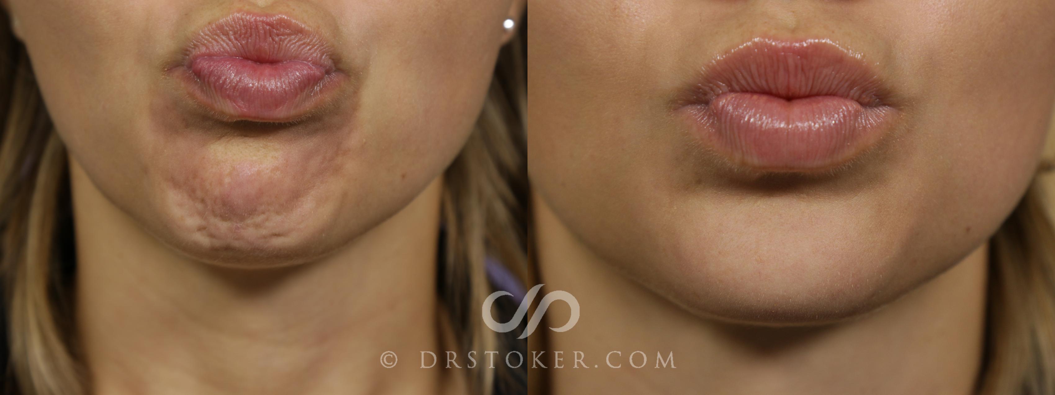 Before & After BOTOX®, Dysport®, & Jeuveau® Case 1635 View #1 View in Marina del Rey, CA