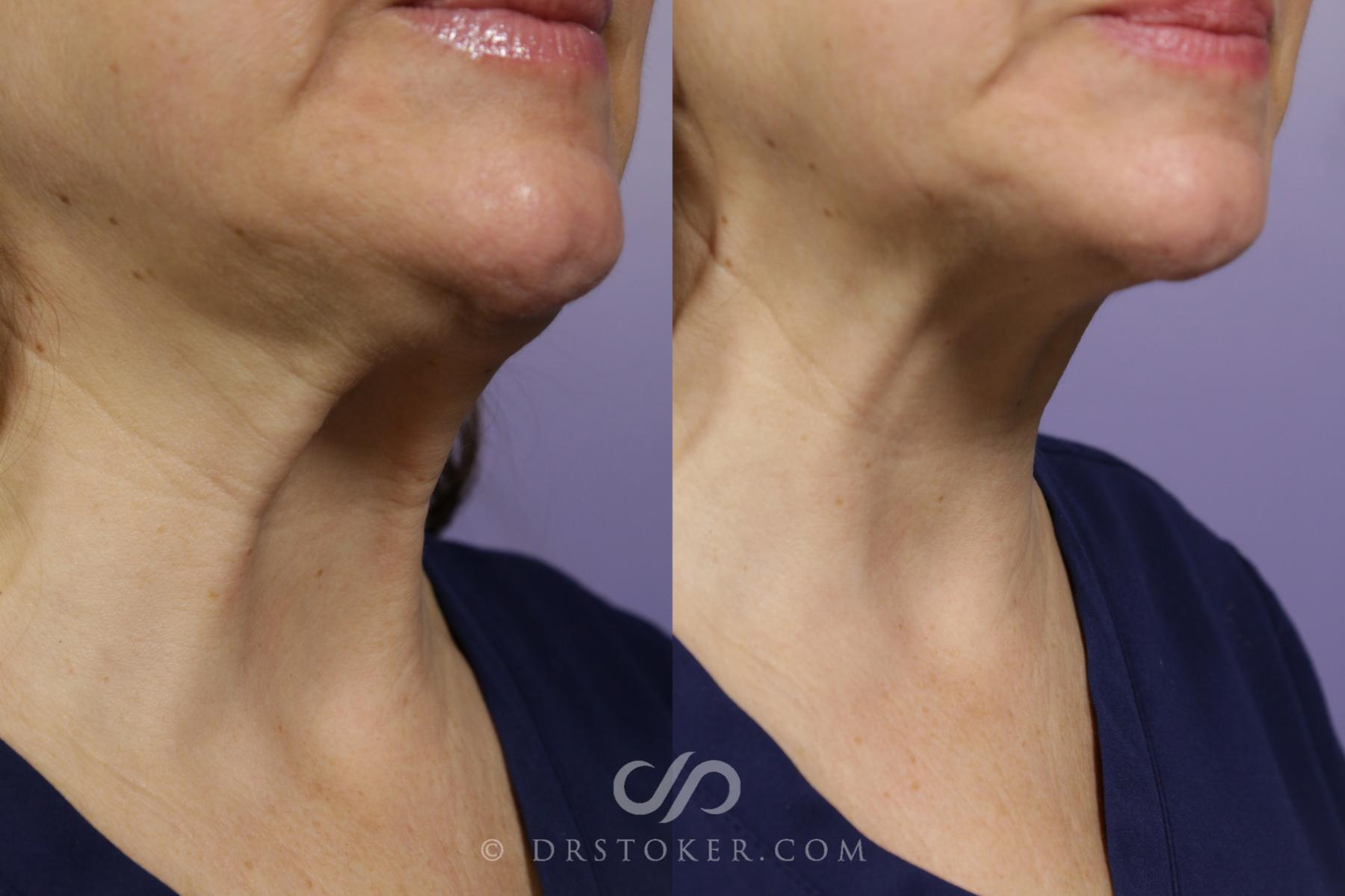 Before & After BOTOX®, Dysport®, & Jeuveau® Case 1636 View #1 View in Los Angeles, CA
