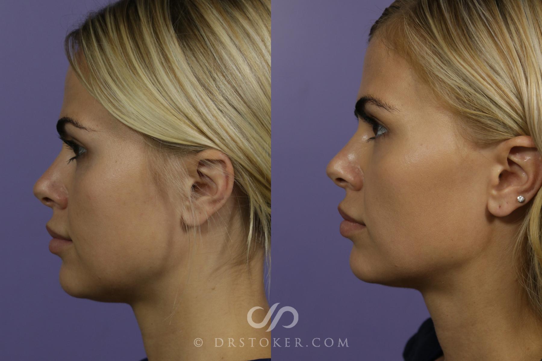 Before & After BOTOX®, Dysport®, & Jeuveau® Case 1637 View #1 View in Los Angeles, CA