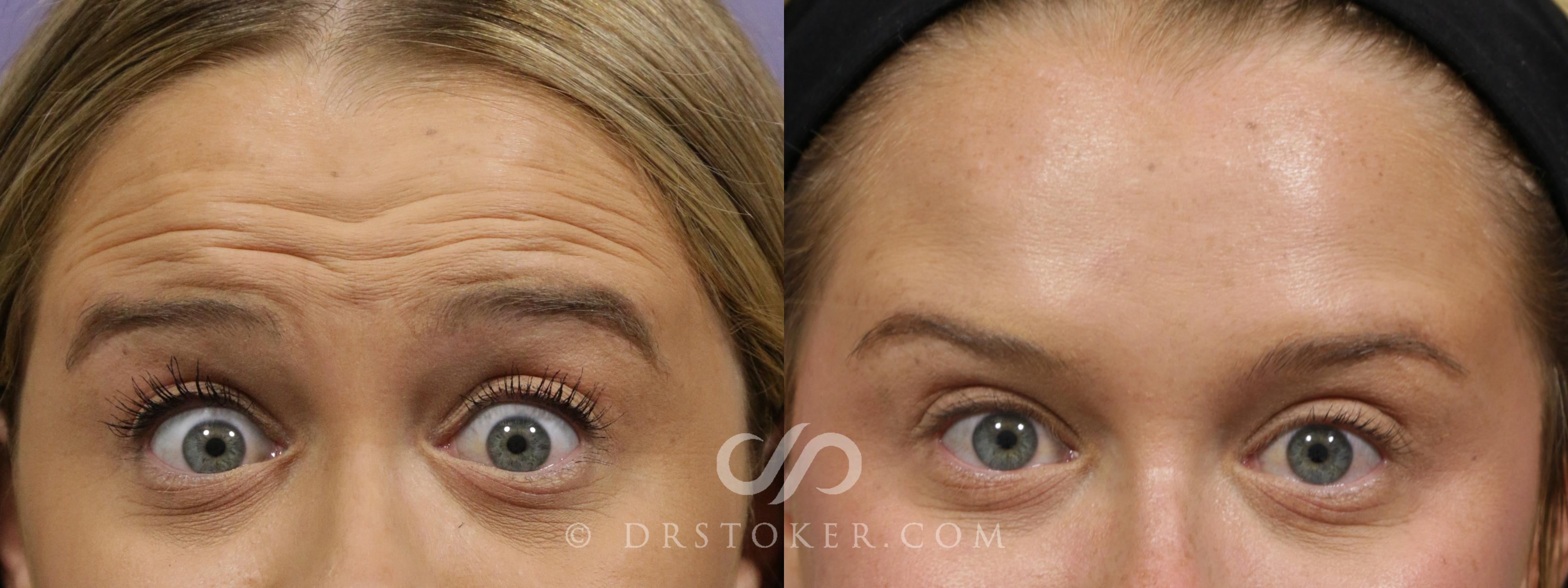 Before & After BOTOX®, Dysport®, & Jeuveau® Case 1856 Front View in Los Angeles, CA