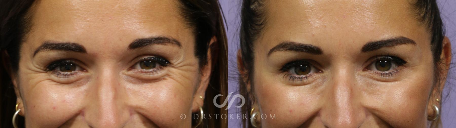 Before & After BOTOX®, Dysport®, & Jeuveau® Case 1871 Front View in Los Angeles, CA