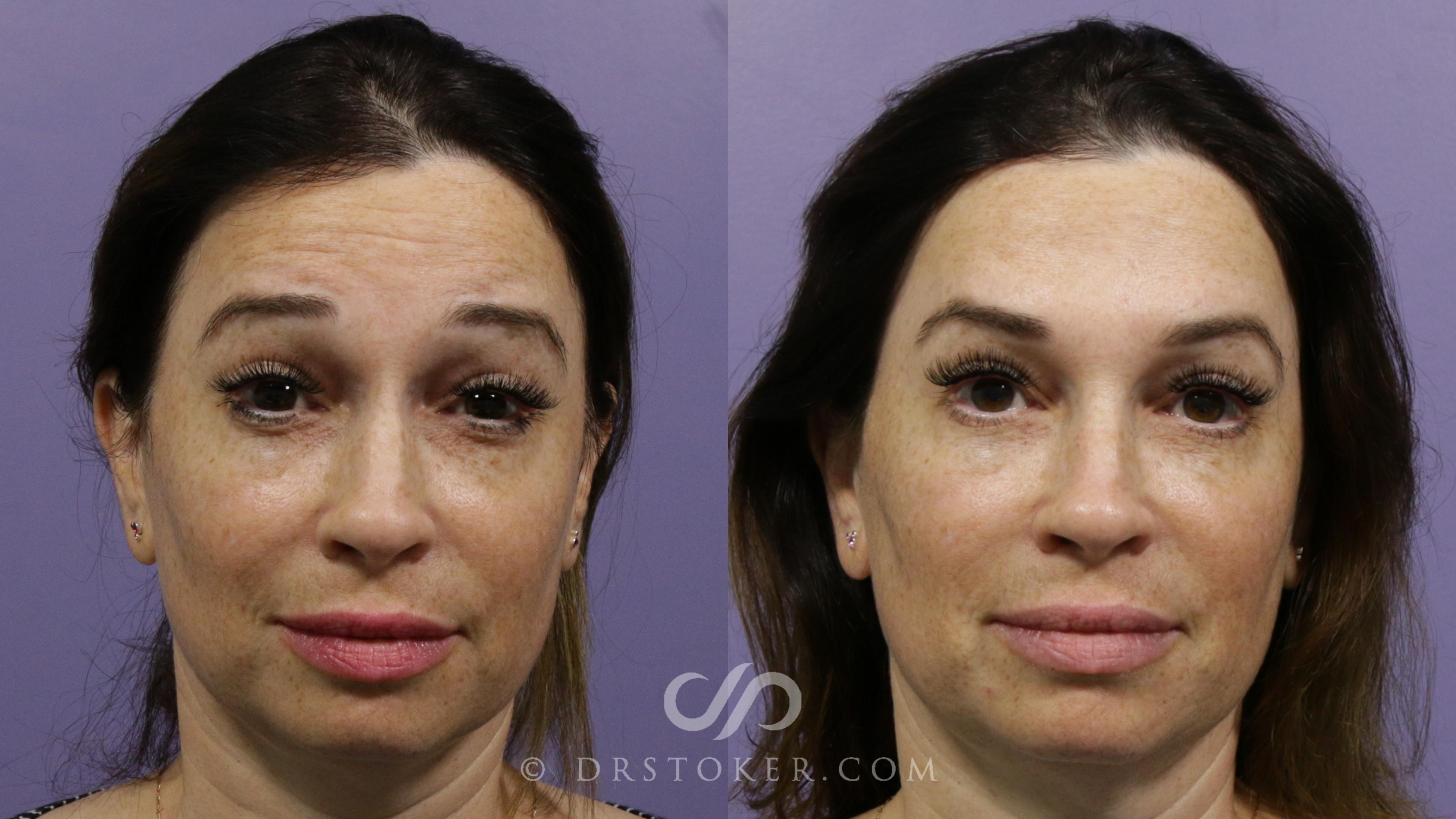 Before & After BOTOX®, Dysport®, & Jeuveau® Case 1880 Front View in Los Angeles, CA