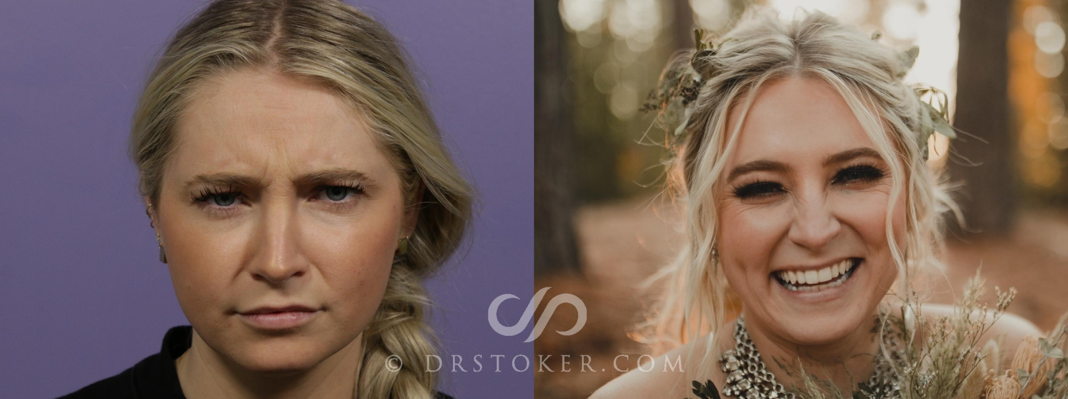 Before & After BOTOX®, Dysport®, & Jeuveau® Case 1981 Front View in Marina del Rey, CA