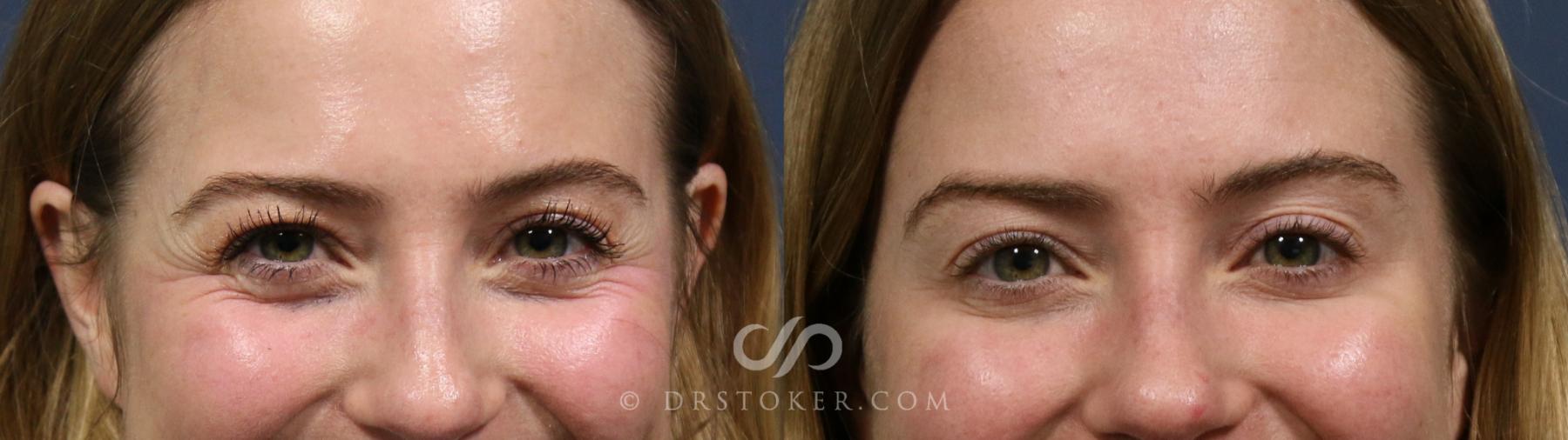 Before & After BOTOX®, Dysport®, & Jeuveau® Case 2264 Front View in Los Angeles, CA