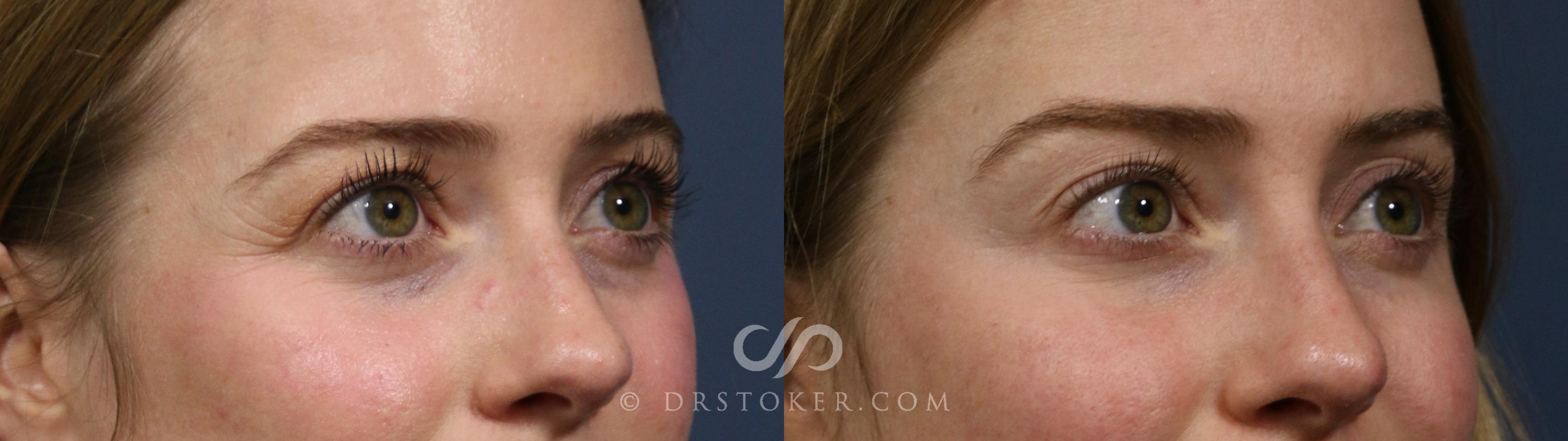 Before & After BOTOX®, Dysport®, & Jeuveau® Case 2265 Right Oblique View in Los Angeles, CA