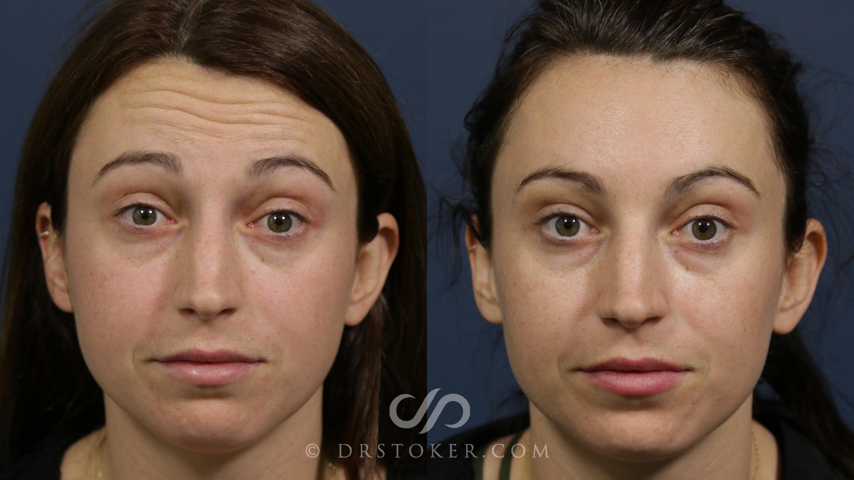 Before & After BOTOX®, Dysport®, & Jeuveau® Case 2291 Front View in Los Angeles, CA