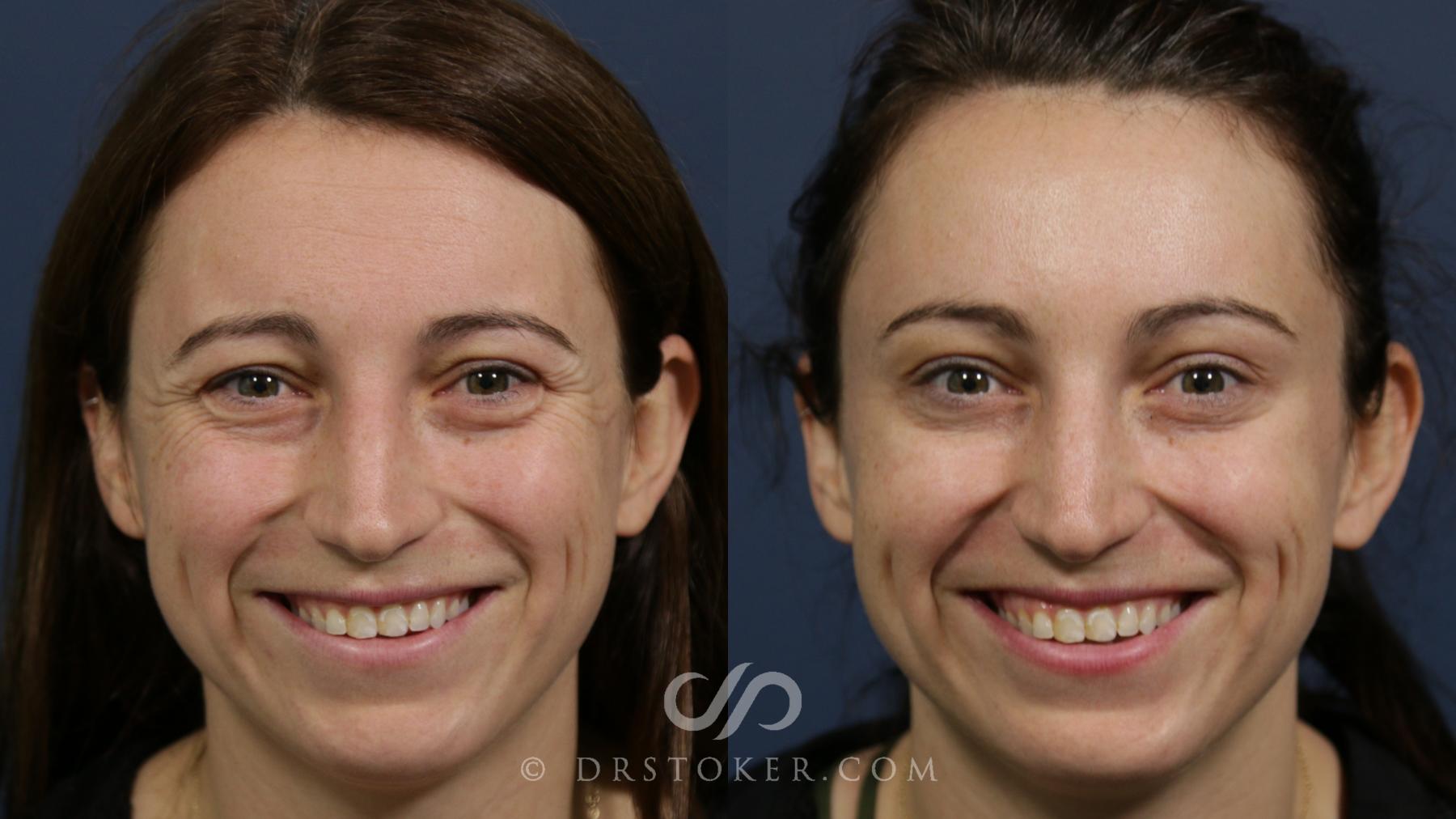 Before & After BOTOX®, Dysport®, & Jeuveau® Case 2292 Front View in Los Angeles, CA