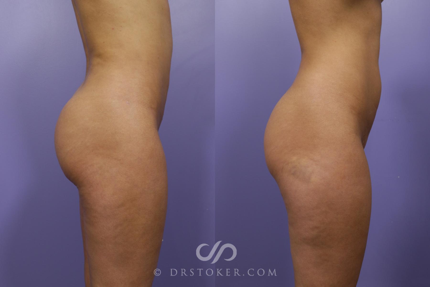 Before & After Brazilian Butt Lift (Fat Grafts to Buttocks) Case 1257 View #1 View in Los Angeles, CA