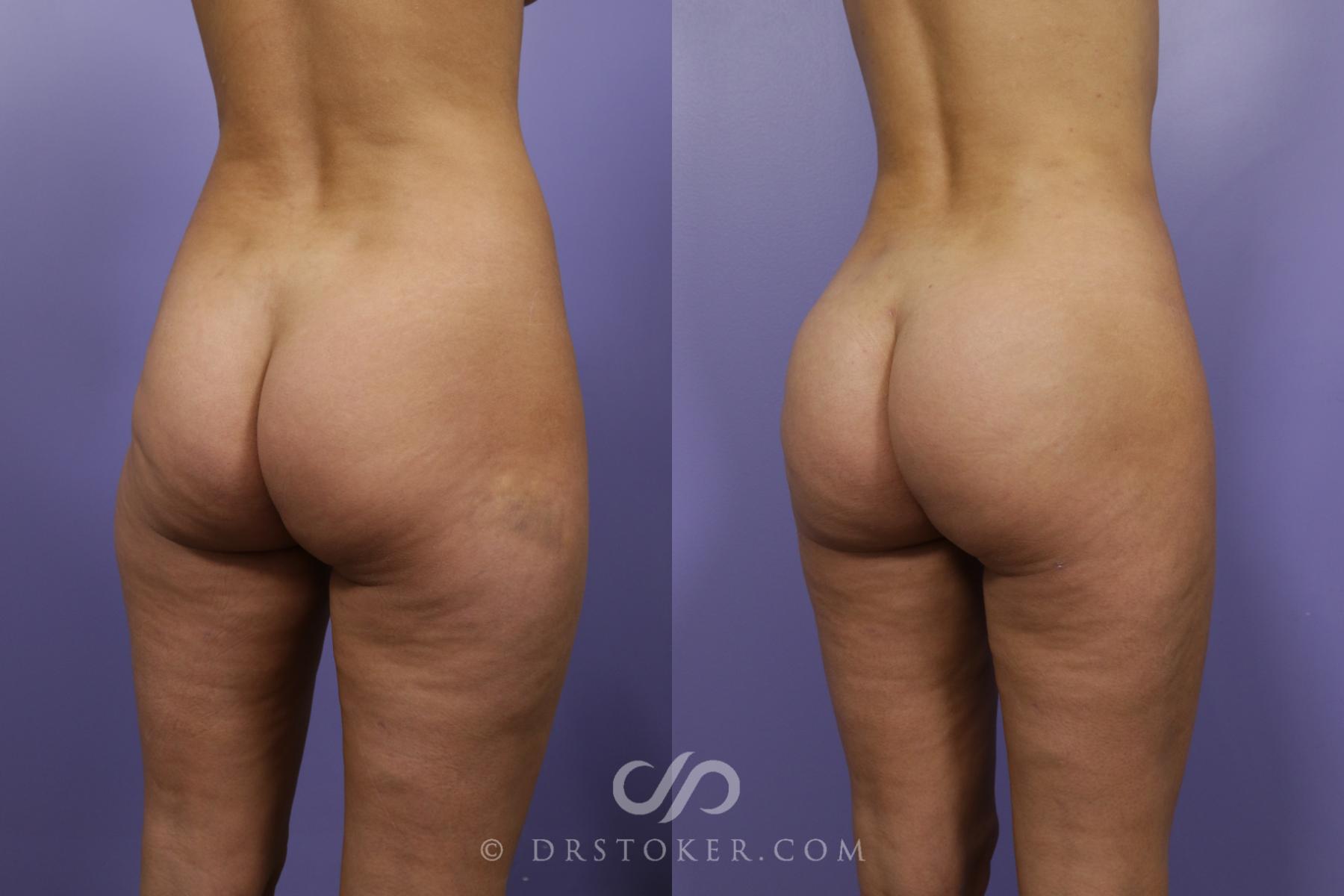 Before & After Brazilian Butt Lift (Fat Grafts to Buttocks) Case 1258 View #1 View in Los Angeles, CA