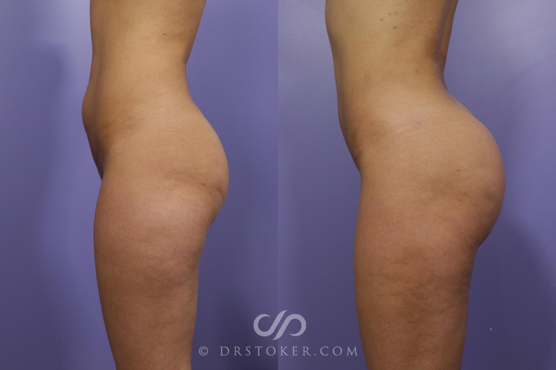 Before & After Brazilian Butt Lift (Fat Grafts to Buttocks) Case 1259 View #1 View in Los Angeles, CA