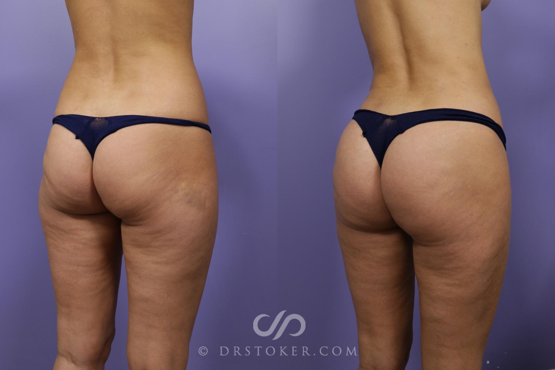 Before & After Brazilian Butt Lift (Fat Grafts to Buttocks) Case 1260 View #1 View in Los Angeles, CA