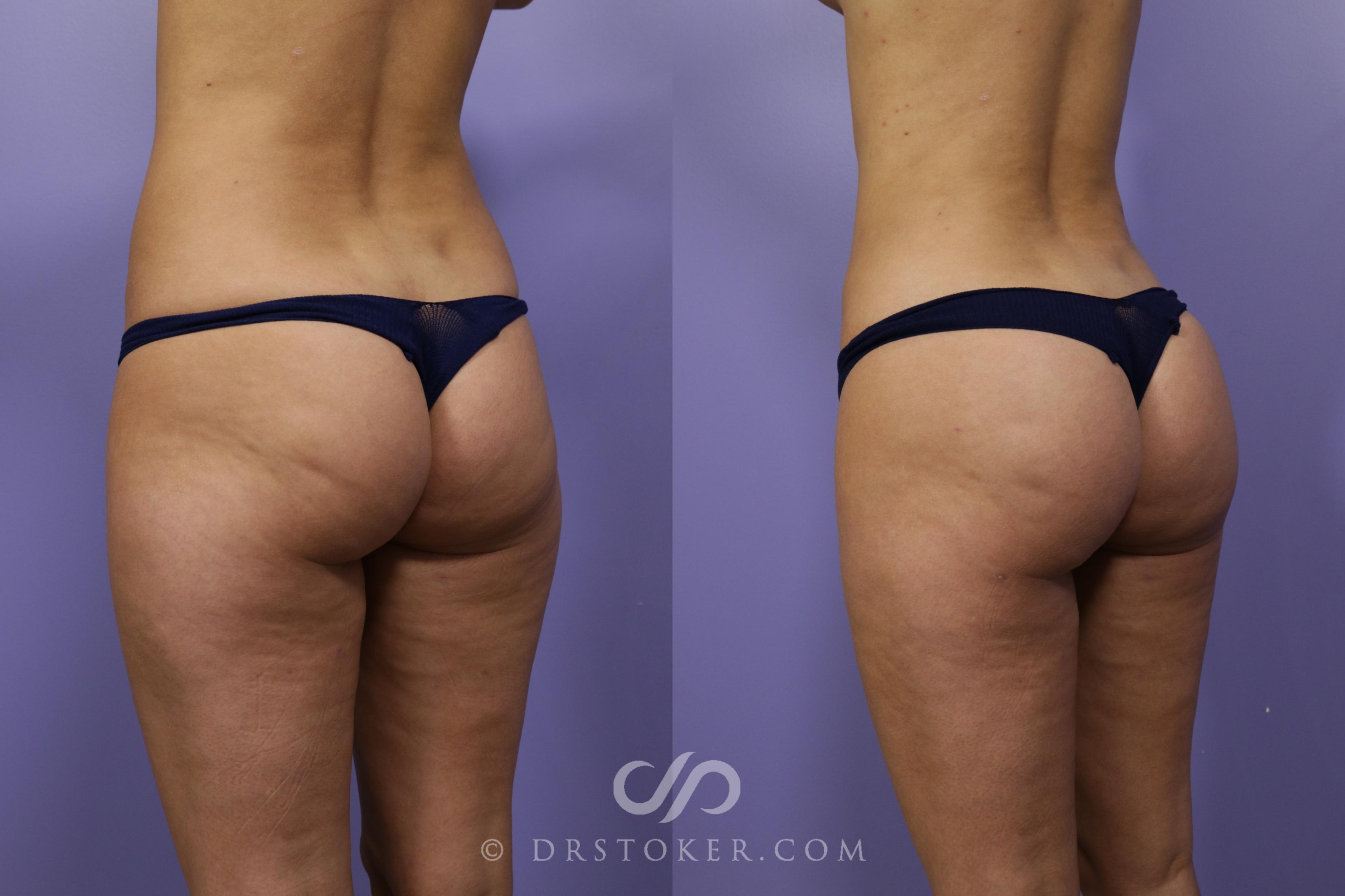 Before & After Liposuction Case 1261 View #1 View in Los Angeles, CA