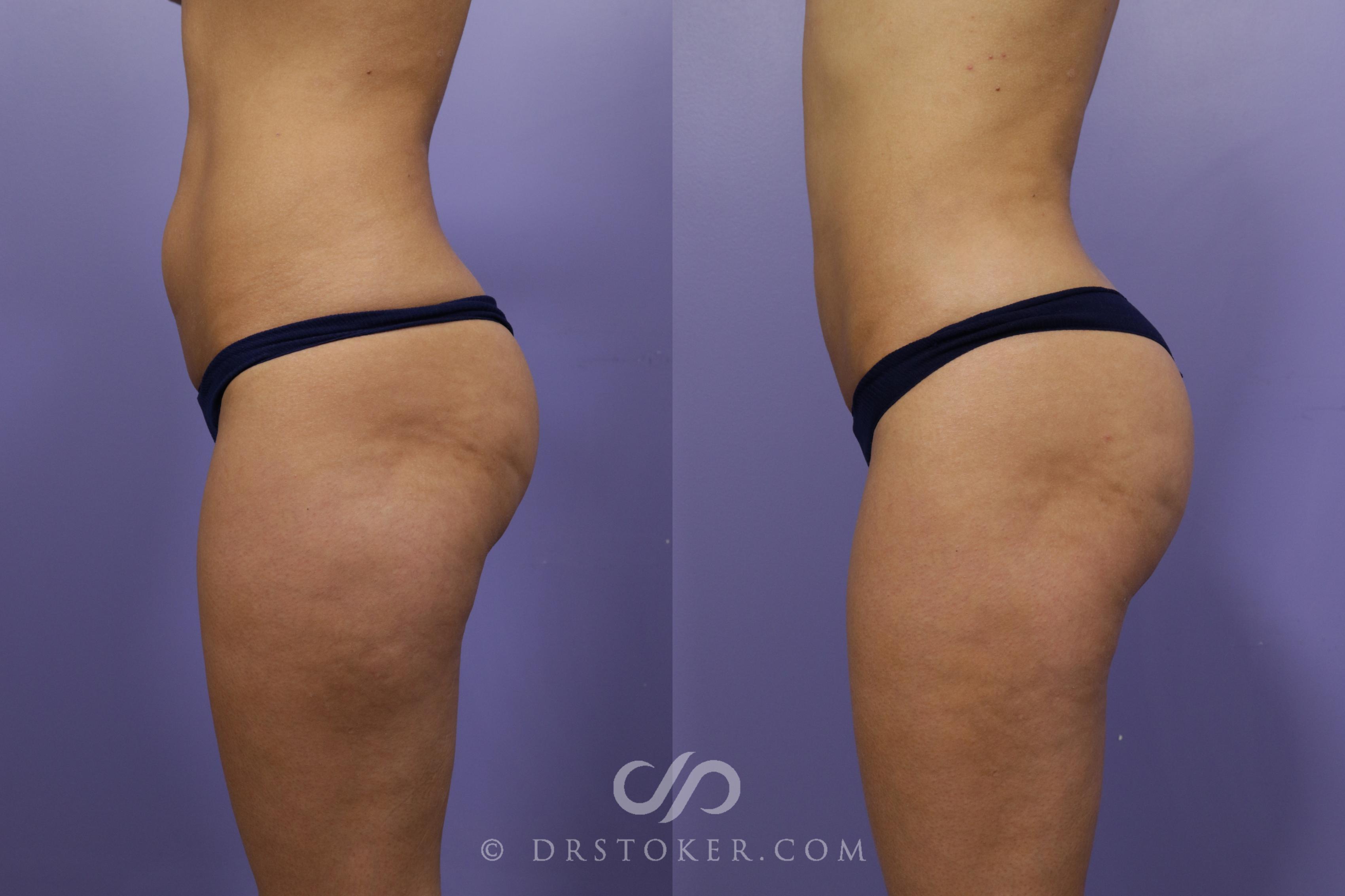 Before & After Liposuction Case 1261 View #2 View in Los Angeles, CA