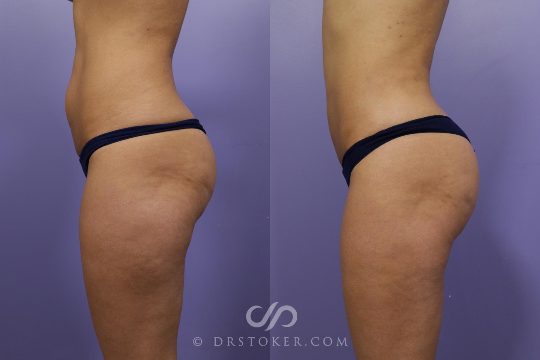 Brazilian Butt Lift Before & After Gallery: Patient 24
