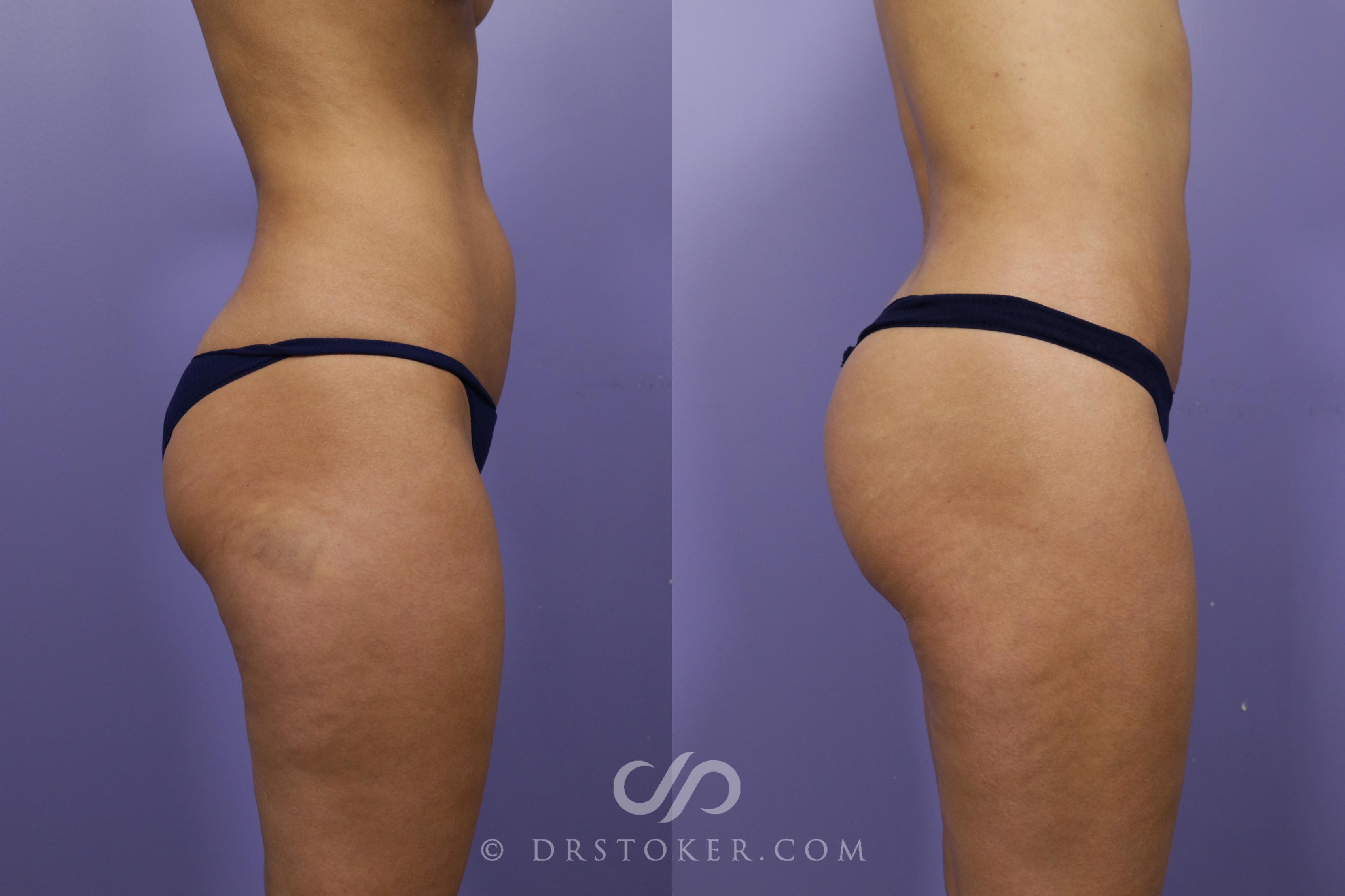 Before & After Brazilian Butt Lift (Fat Grafts to Buttocks) Case 1262 View #1 View in Los Angeles, CA