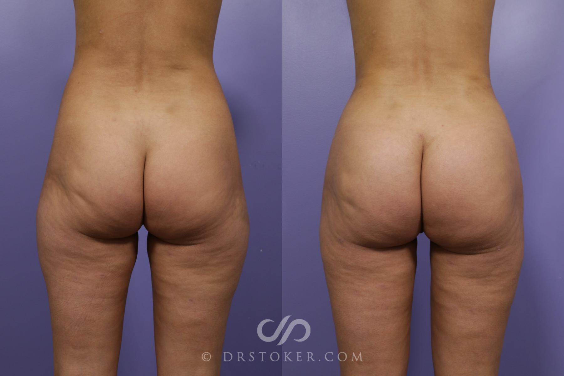 Before & After Brazilian Butt Lift (Fat Grafts to Buttocks) Case 1263 View #1 View in Los Angeles, CA