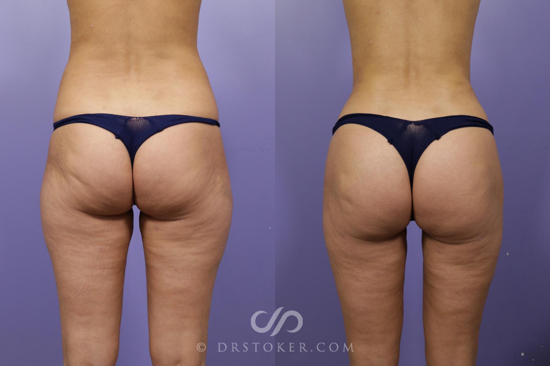 Before & After Brazilian Butt Lift (Fat Grafts to Buttocks) Case 1264 View #1 View in Los Angeles, CA