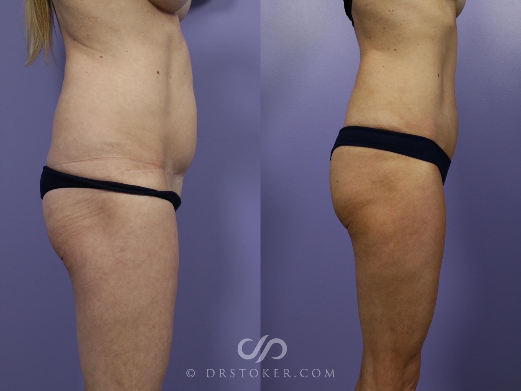 Before & After Brazilian Butt Lift (Fat Grafts to Buttocks) Case 1265 View #1 View in Los Angeles, CA