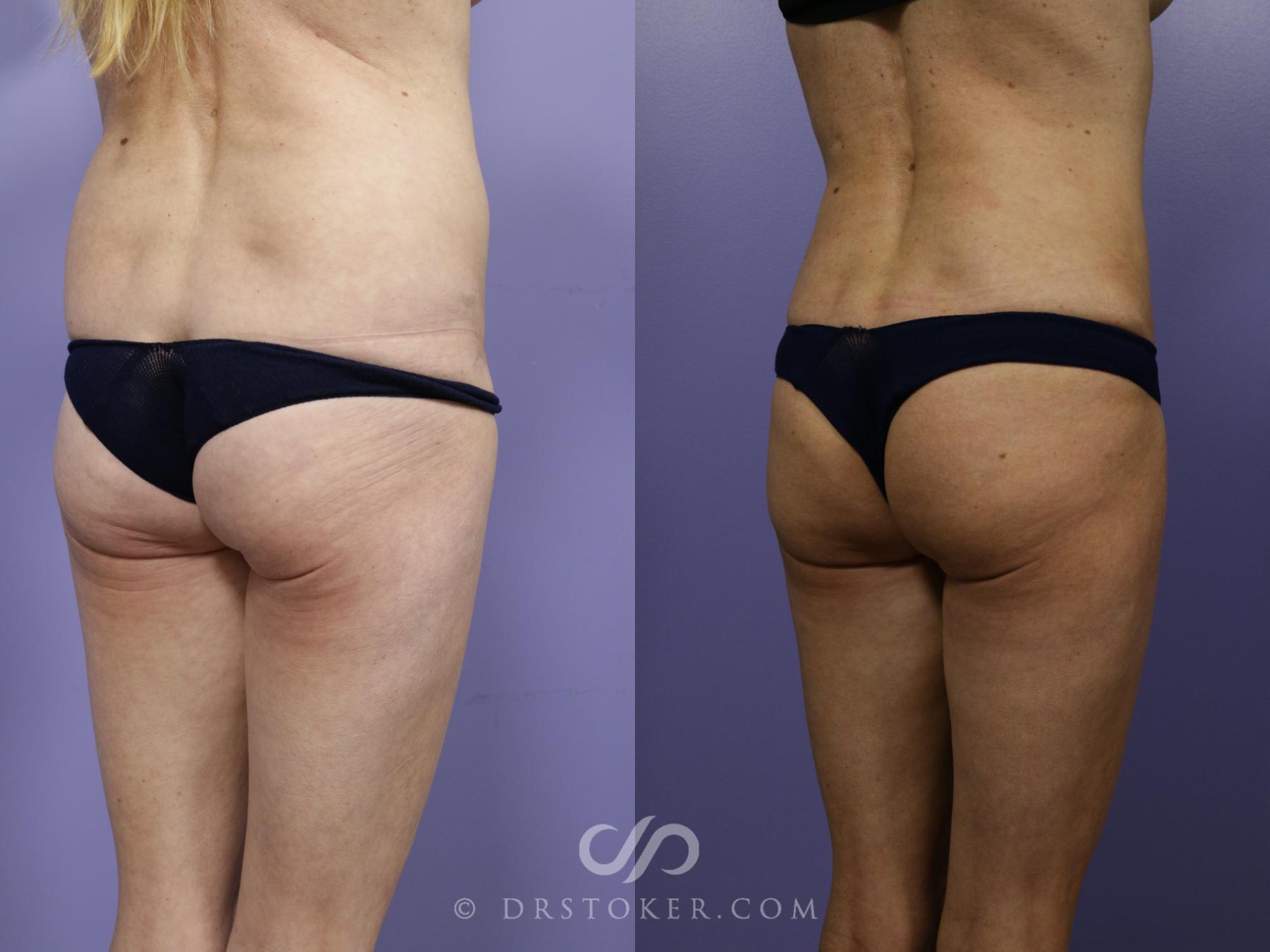 Before & After Brazilian Butt Lift (Fat Grafts to Buttocks) Case 1265 View #2 View in Los Angeles, CA