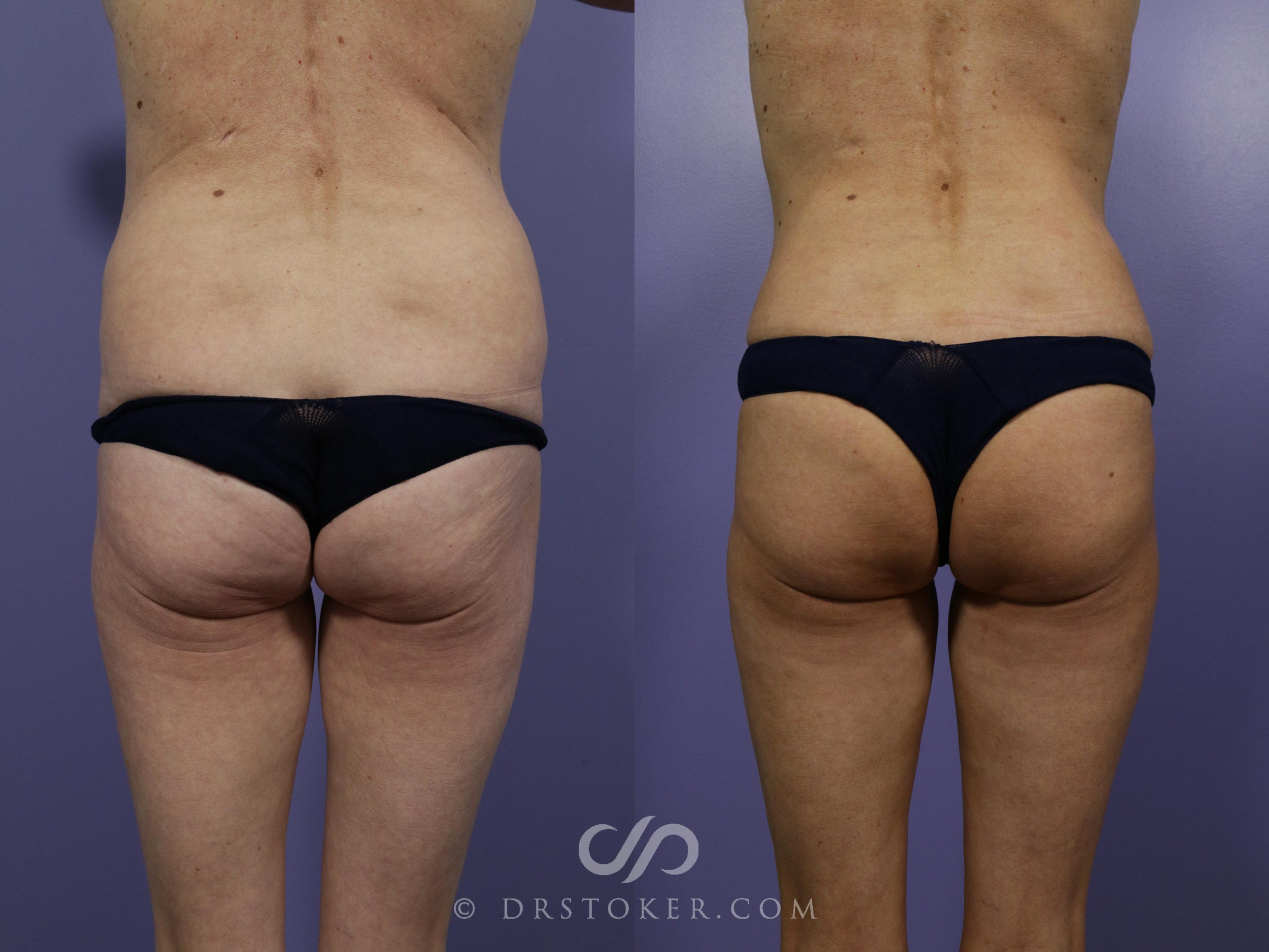 Before & After Brazilian Butt Lift (Fat Grafts to Buttocks) Case 1265 View #3 View in Los Angeles, CA