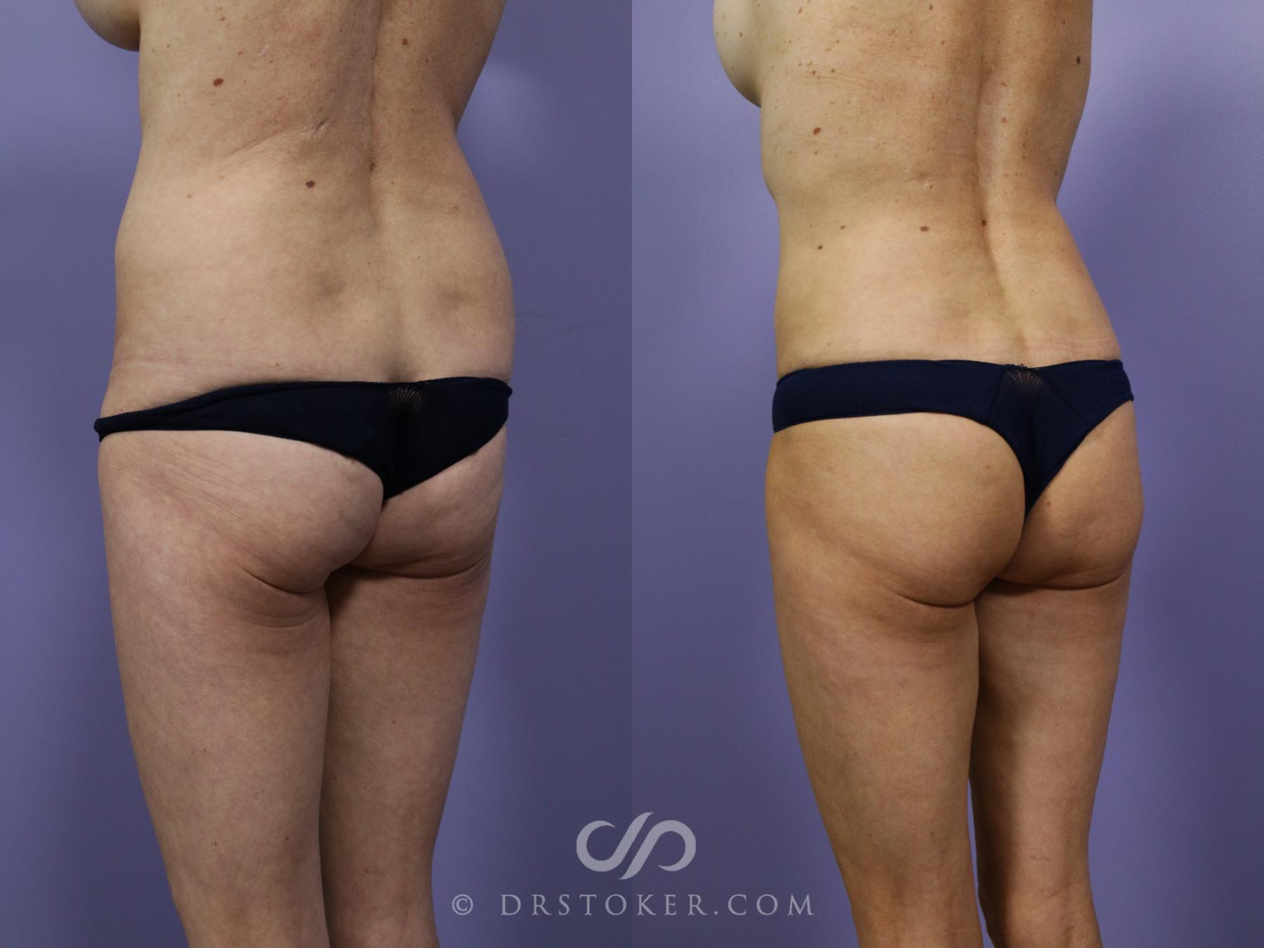 Before & After Brazilian Butt Lift (Fat Grafts to Buttocks) Case 1265 View #4 View in Los Angeles, CA
