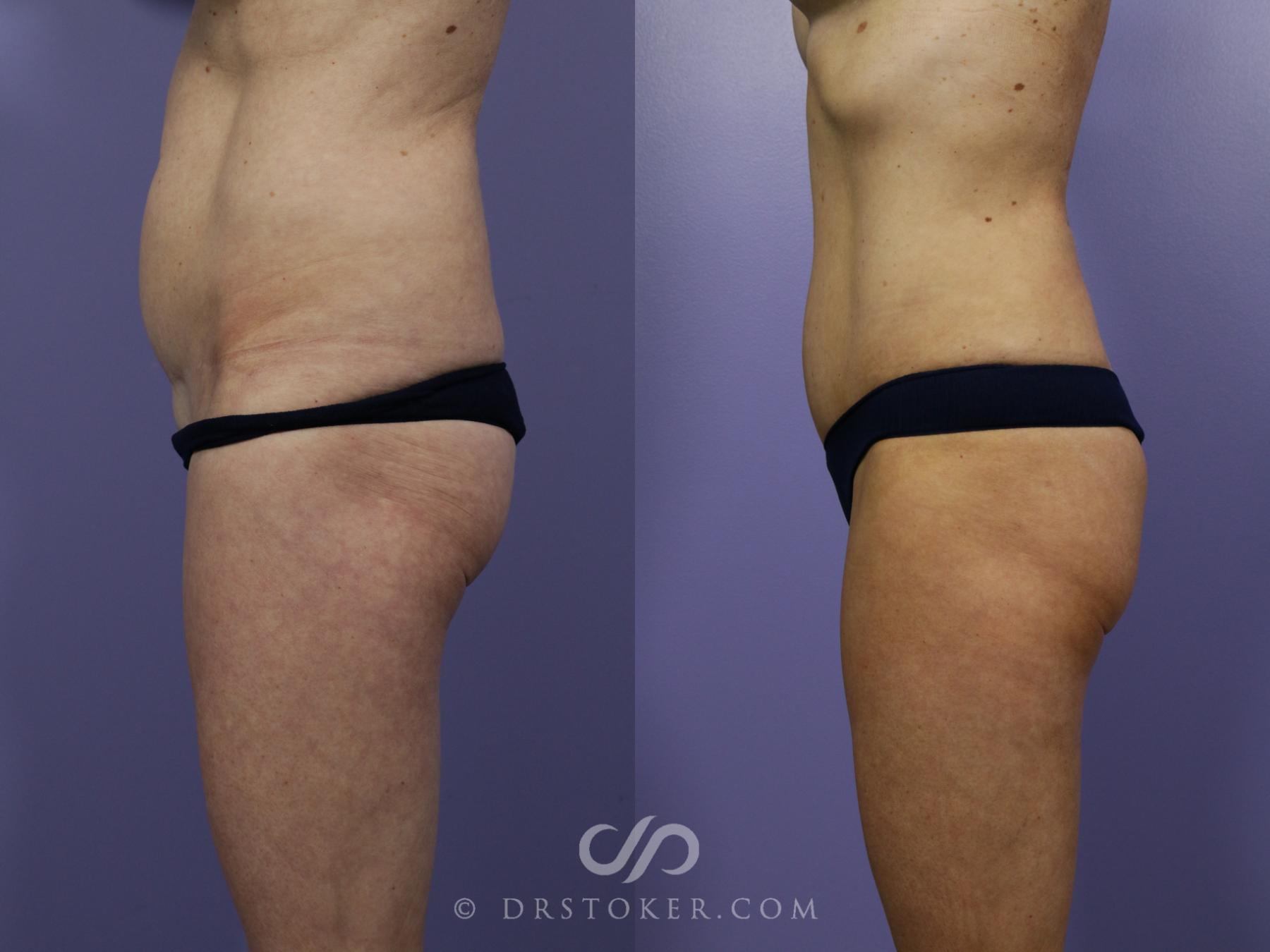 Before & After Brazilian Butt Lift (Fat Grafts to Buttocks) Case 1265 View #5 View in Los Angeles, CA