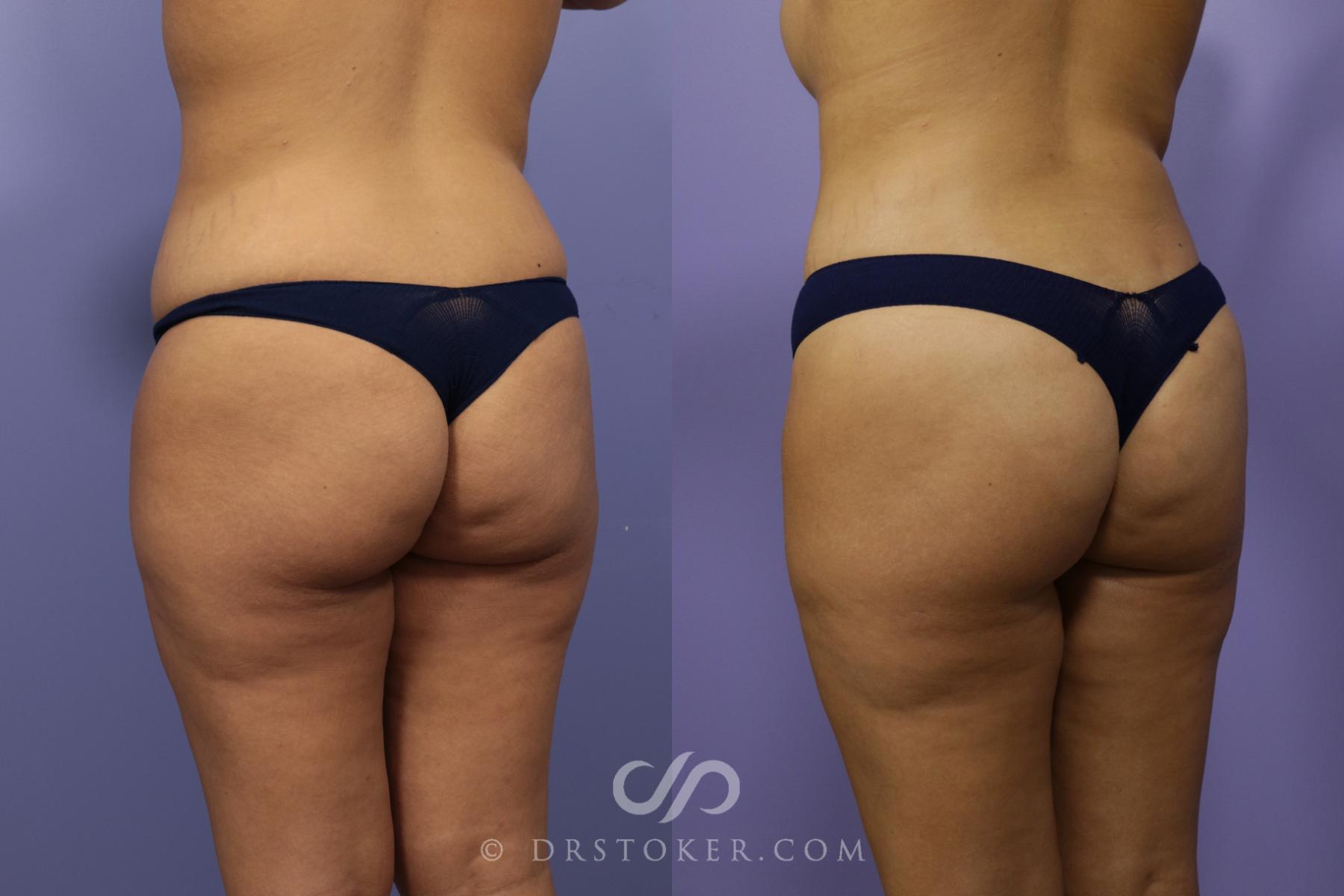 Before & After Brazilian Butt Lift (Fat Grafts to Buttocks) Case 1382 View #1 View in Los Angeles, CA