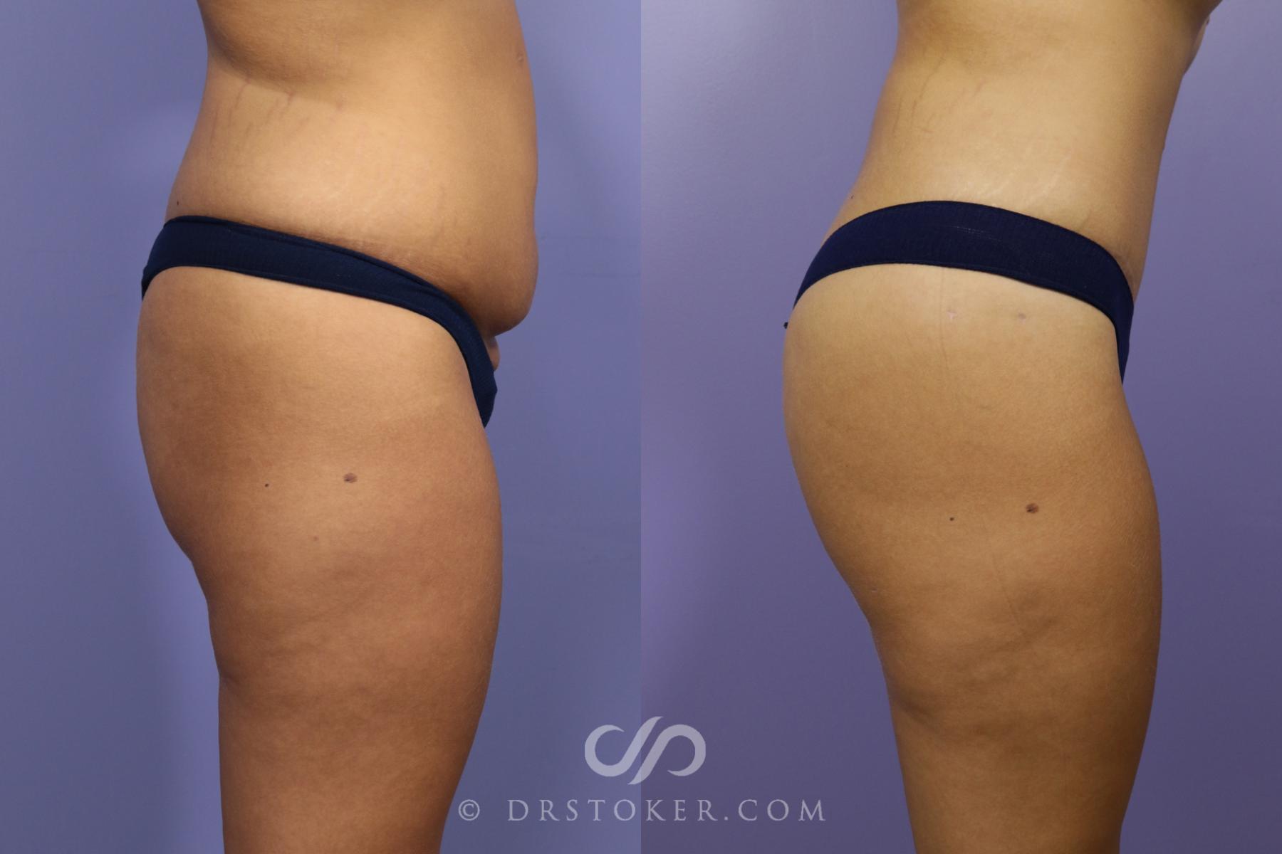 Before & After Brazilian Butt Lift (Fat Grafts to Buttocks) Case 1400 View #1 View in Los Angeles, CA