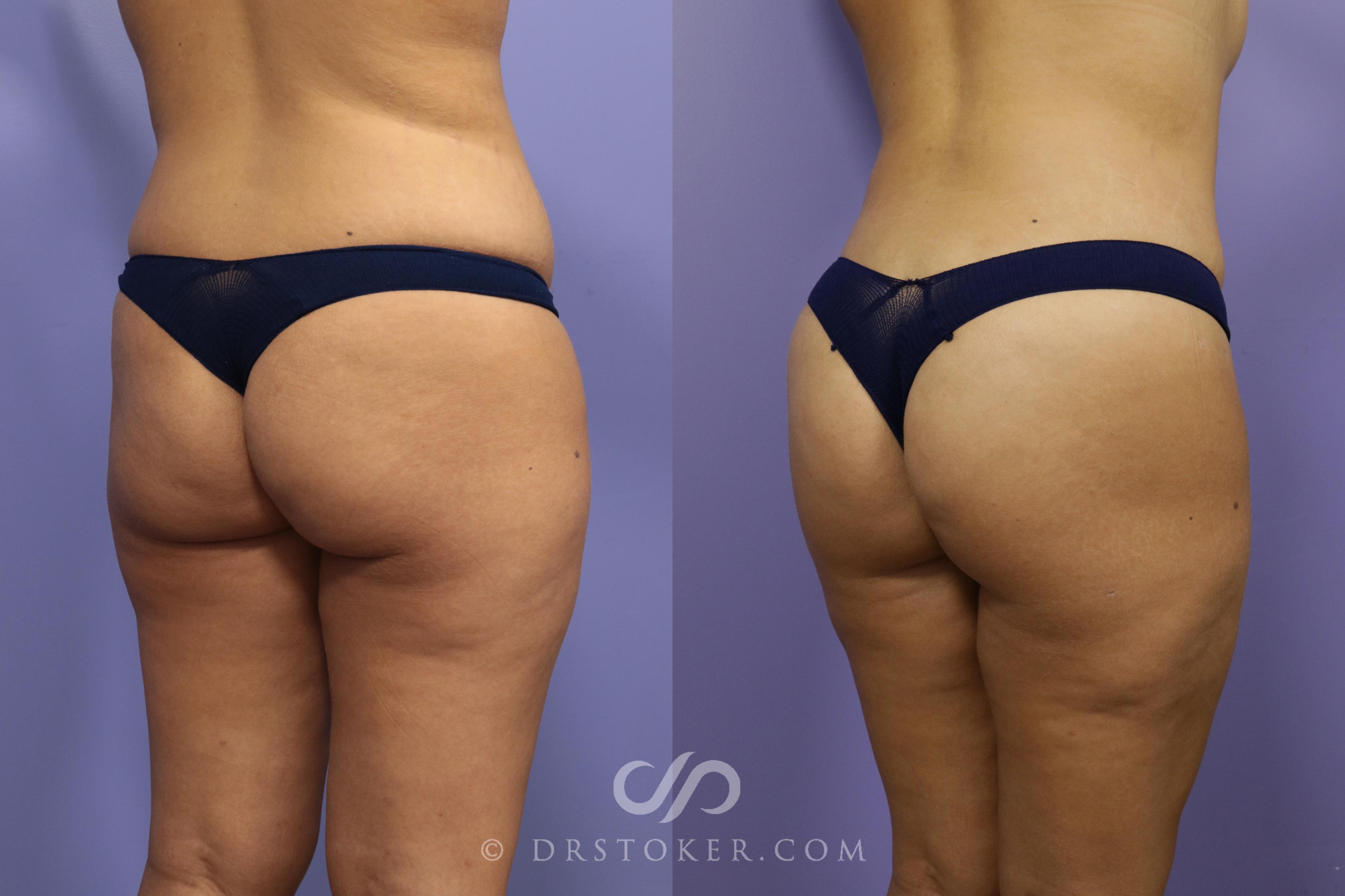 Before & After Brazilian Butt Lift (Fat Grafts to Buttocks) Case 1401 View #1 View in Los Angeles, CA