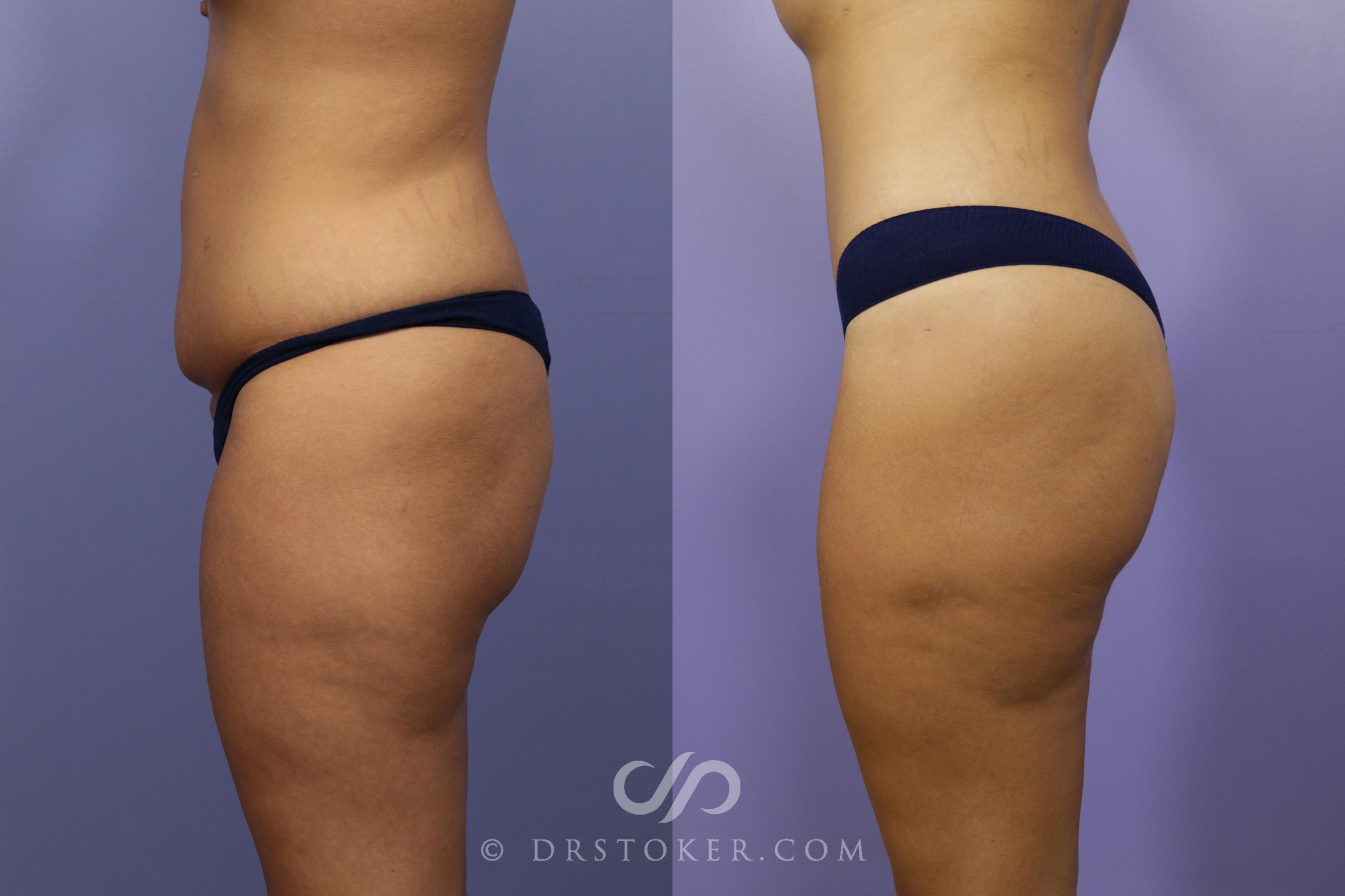 Before & After Brazilian Butt Lift (Fat Grafts to Buttocks) Case 1402 View #1 View in Los Angeles, CA